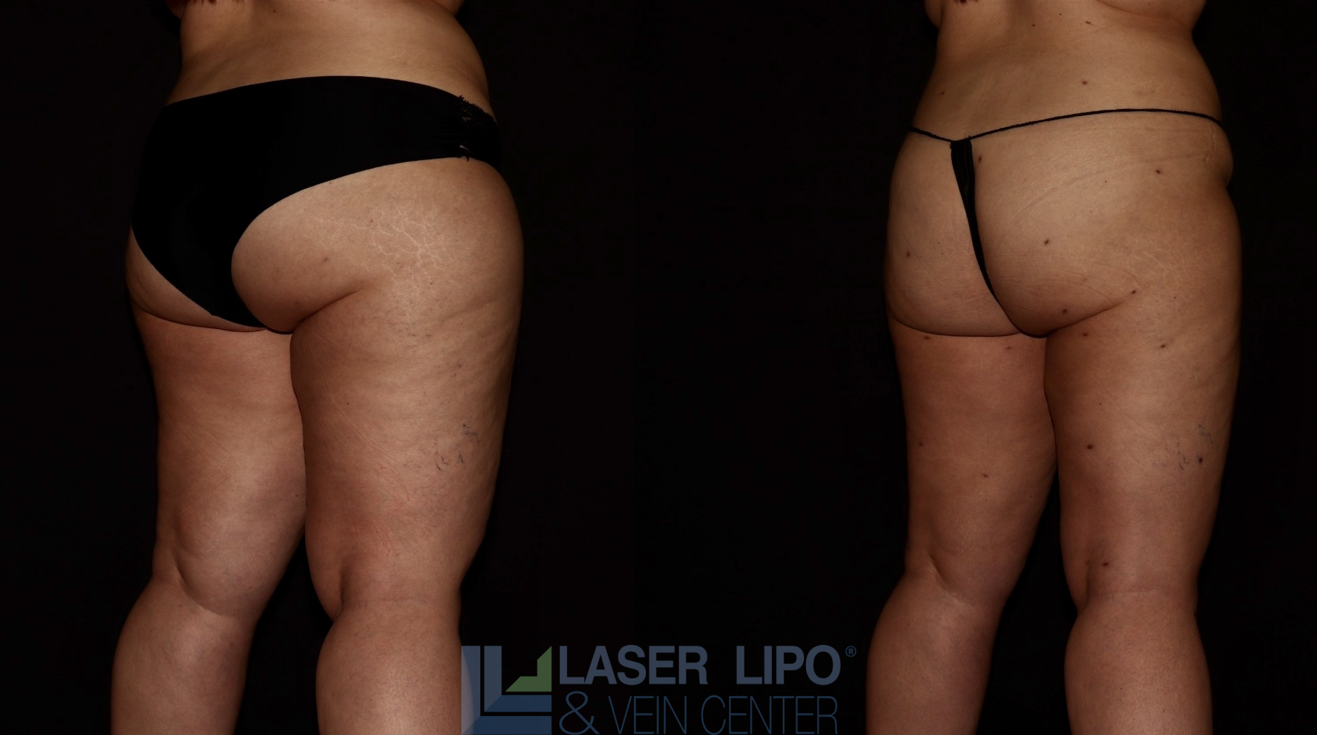 Before and After Image: Lipedema – Hips and Buttocks - right-back-oblique