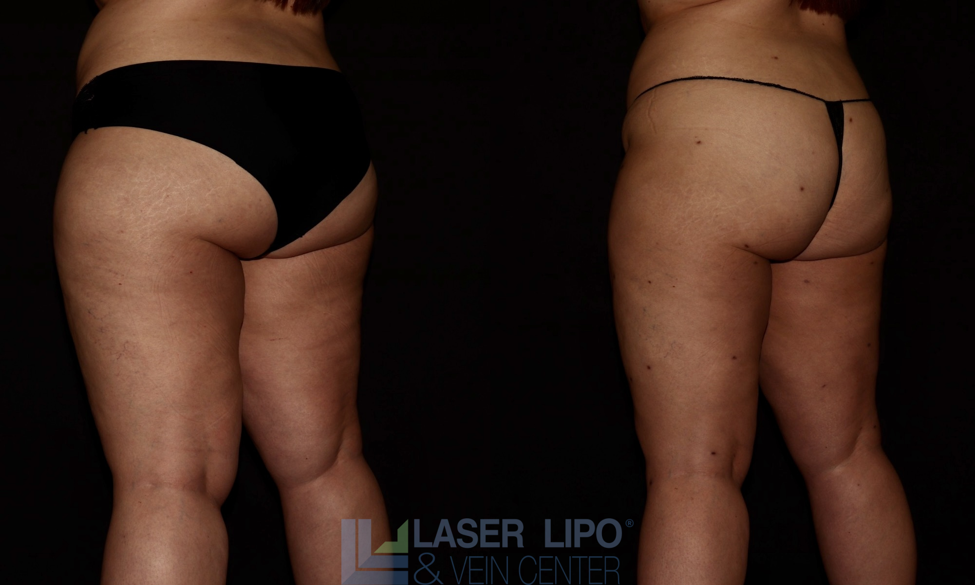 Before and After Image: Lipedema – Hips and Buttocks - left-back-oblique