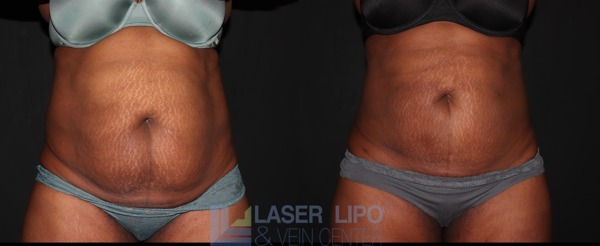 Before and After Image: Liposuction – Abs-Flanks - front