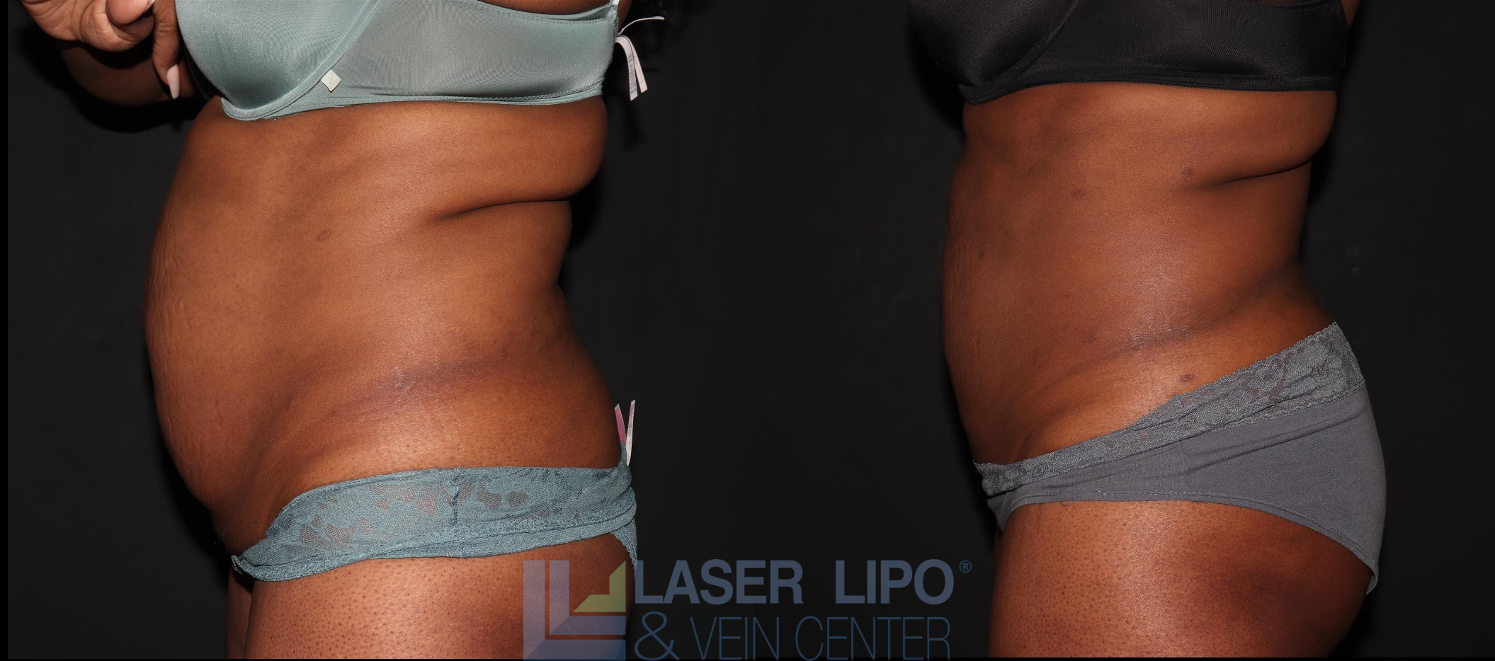 Before and After Image: Liposuction – Abs-Flanks - left-side