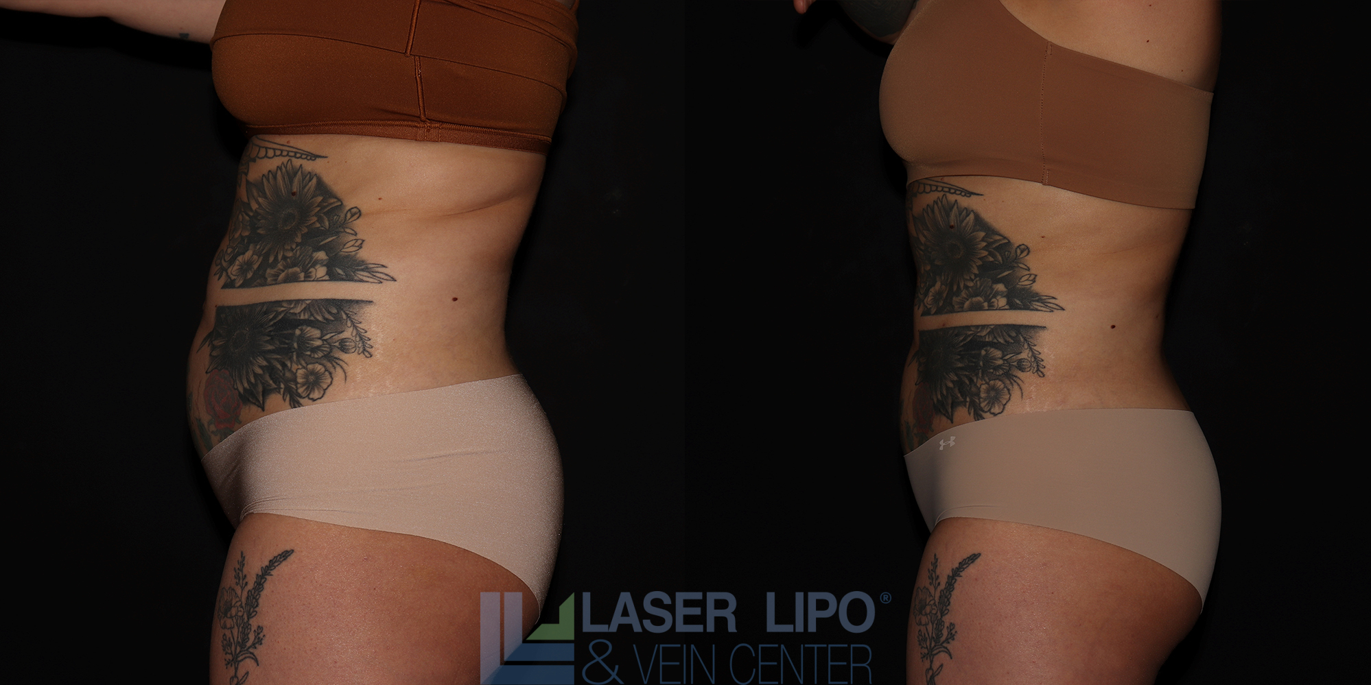 Before and After Image: Liposuction – Abs-Flanks - left-side