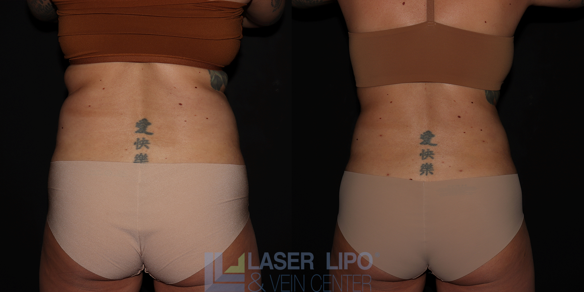 Before and After Image: Liposuction – Abs-Flanks - back