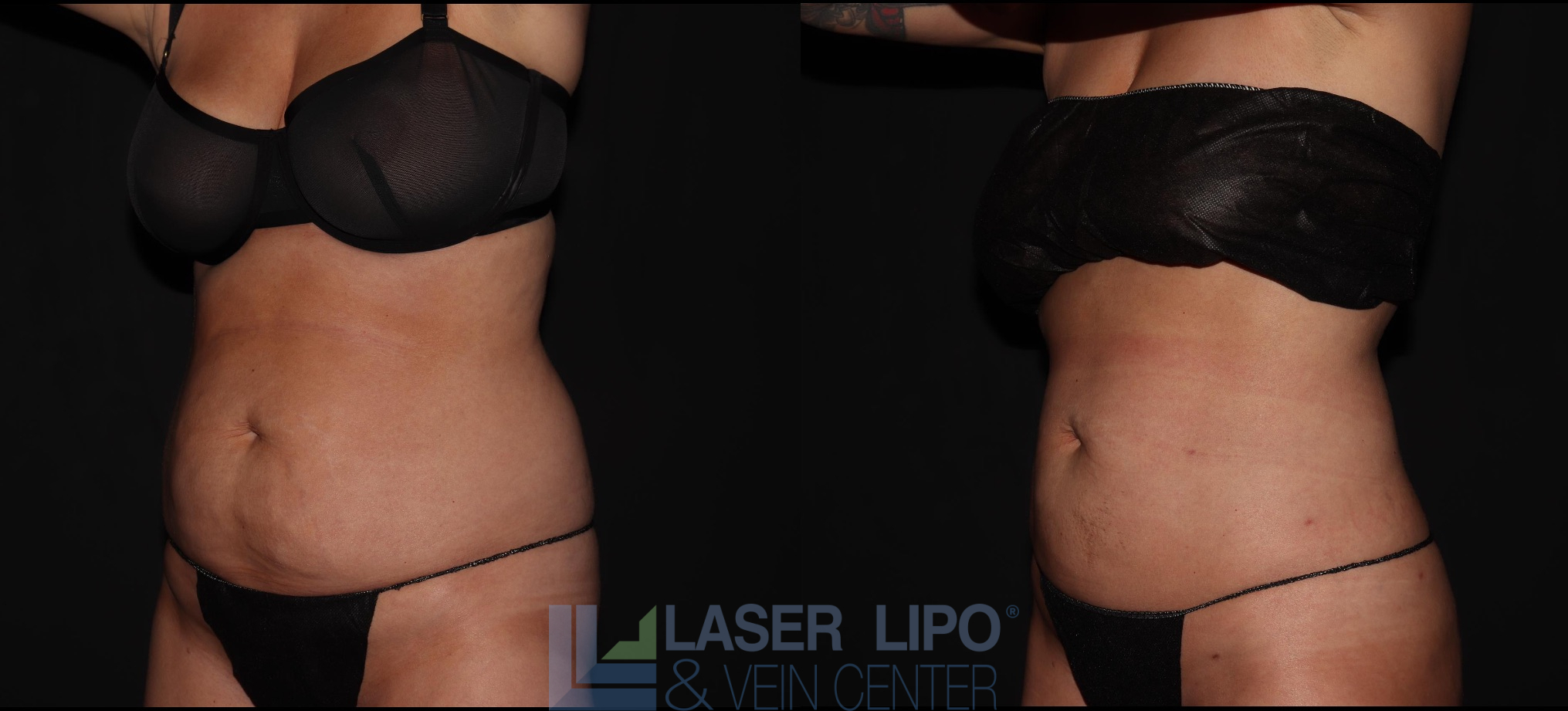 Before and After Image: Liposuction – Abs-Flanks - left-front-oblique