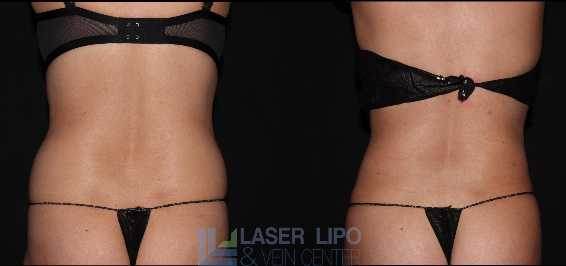 Before and After Image: Liposuction – Abs-Flanks - back