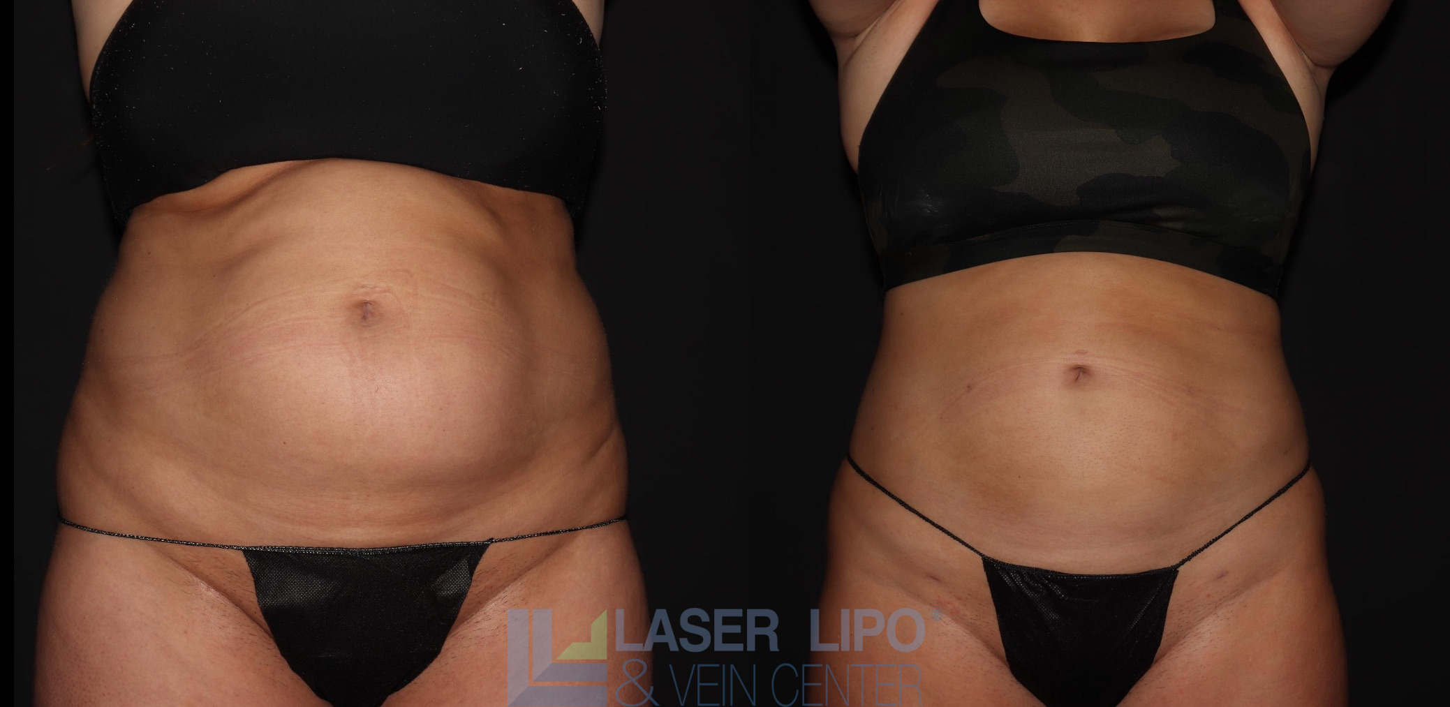 Before and After Image: Liposuction – Abs-Flanks - front