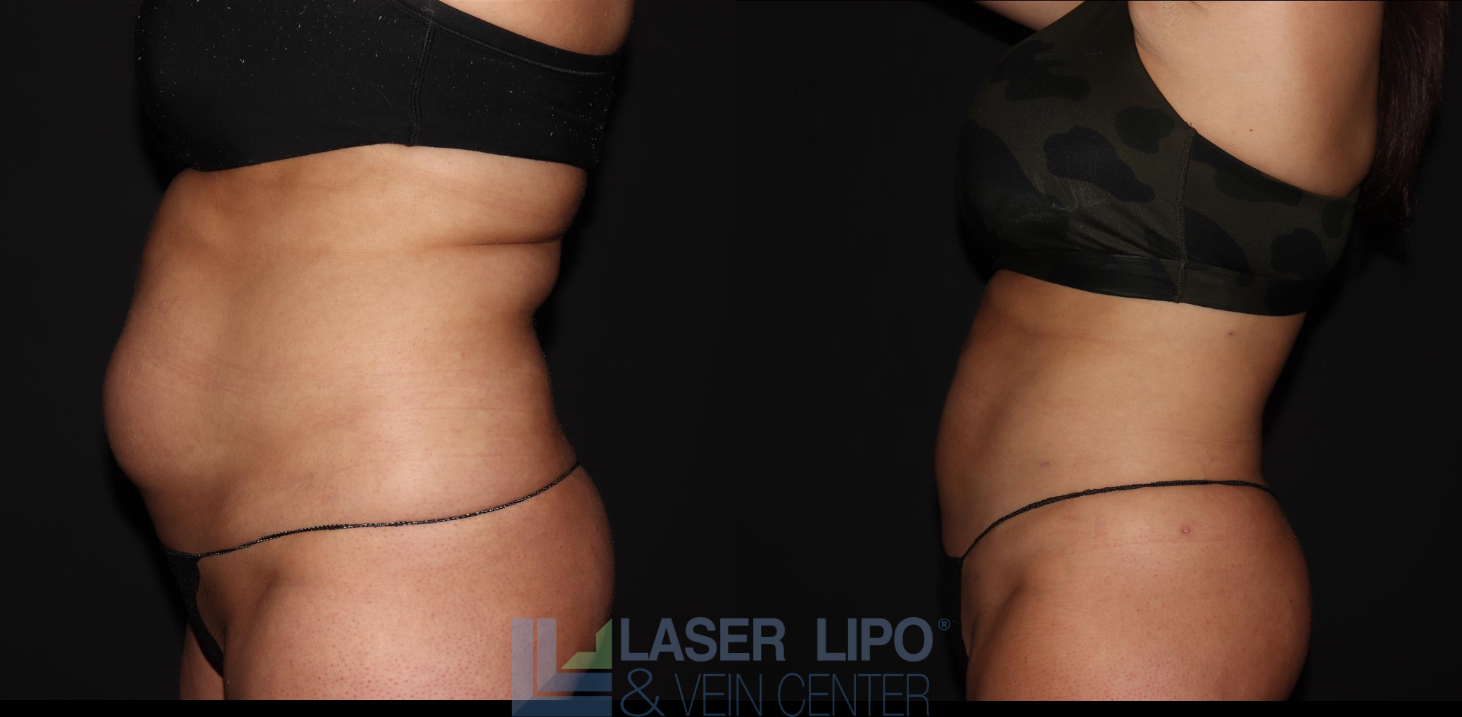 Before and After Image: Liposuction – Abs-Flanks - left-side