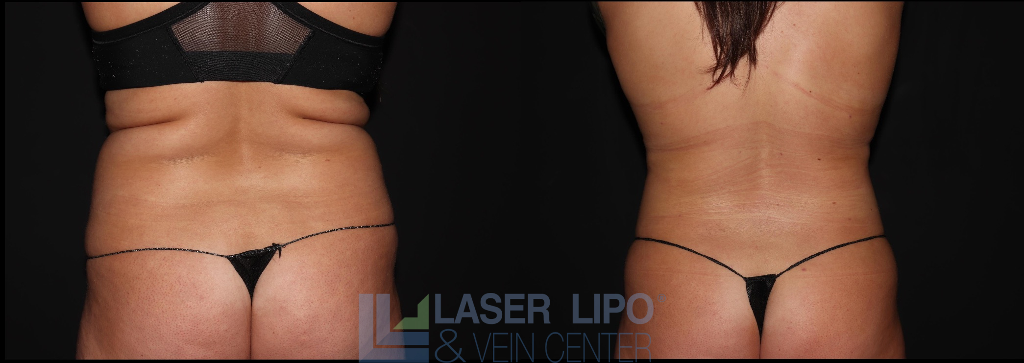 Before and After Image: Liposuction – Abs-Flanks - back