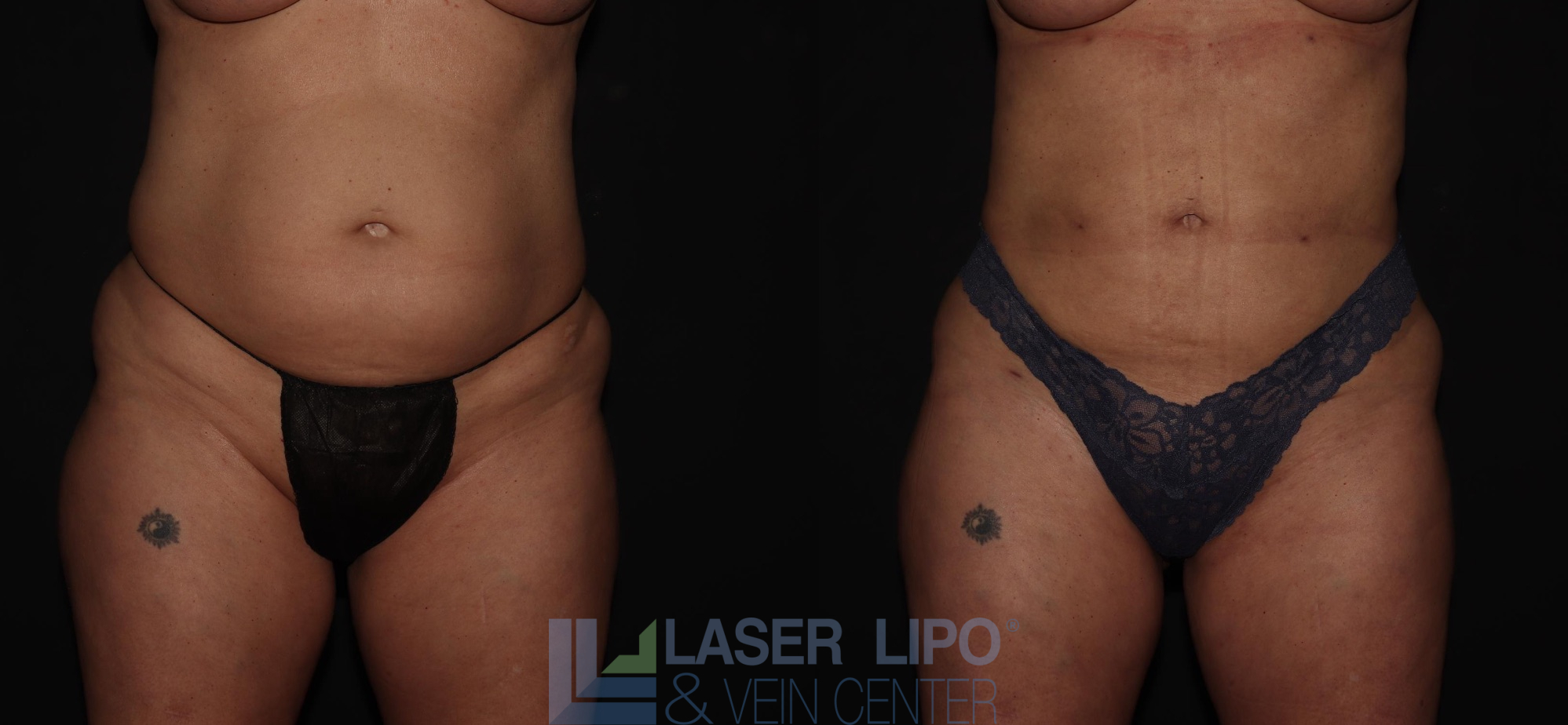 Before and After Image: Liposuction – Abs-Flanks - front
