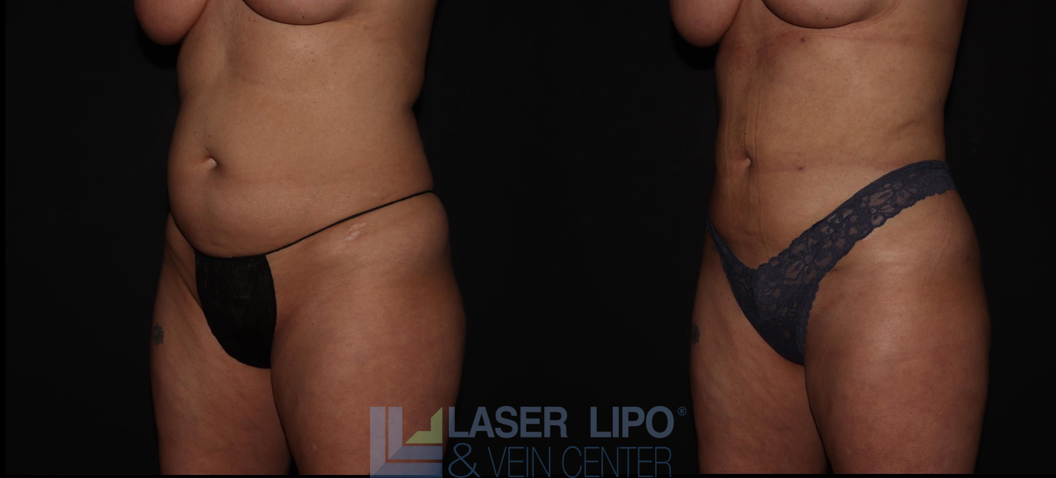 Before and After Image: Liposuction – Abs-Flanks - left-front-oblique