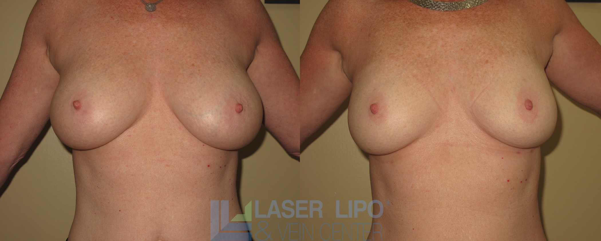 Before and After Image: Lipo/Renuvion to Breast - front
