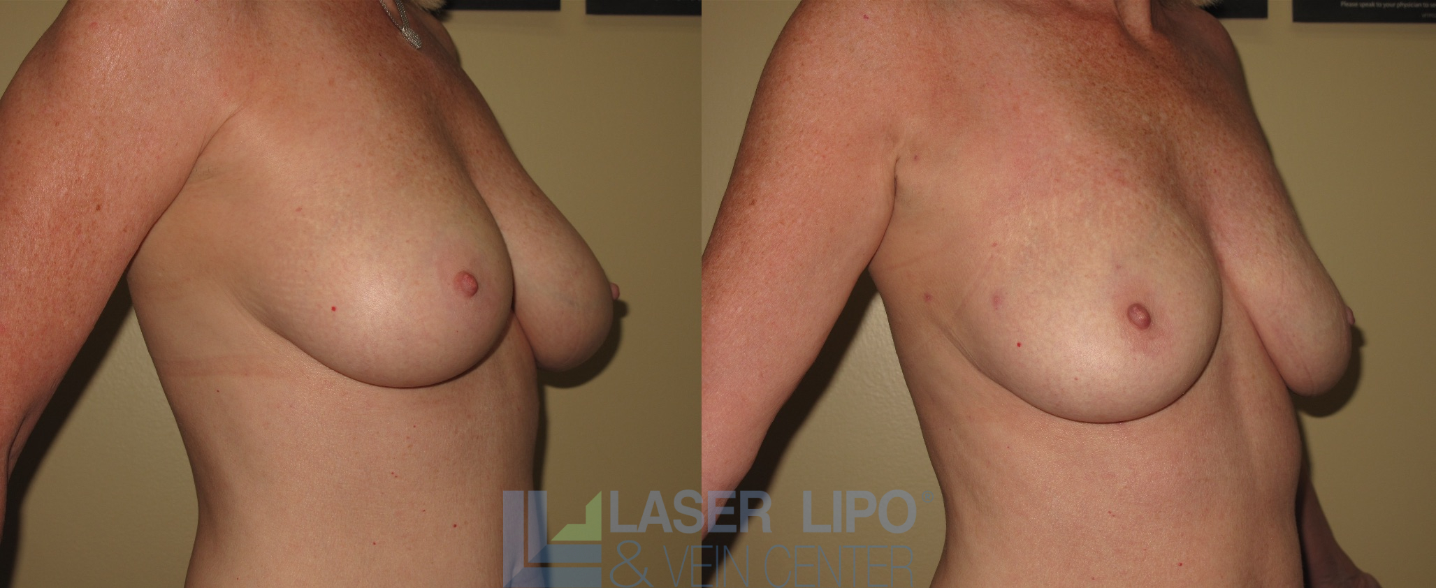 Before and After Image: Lipo/Renuvion to Breast - right-front-oblique