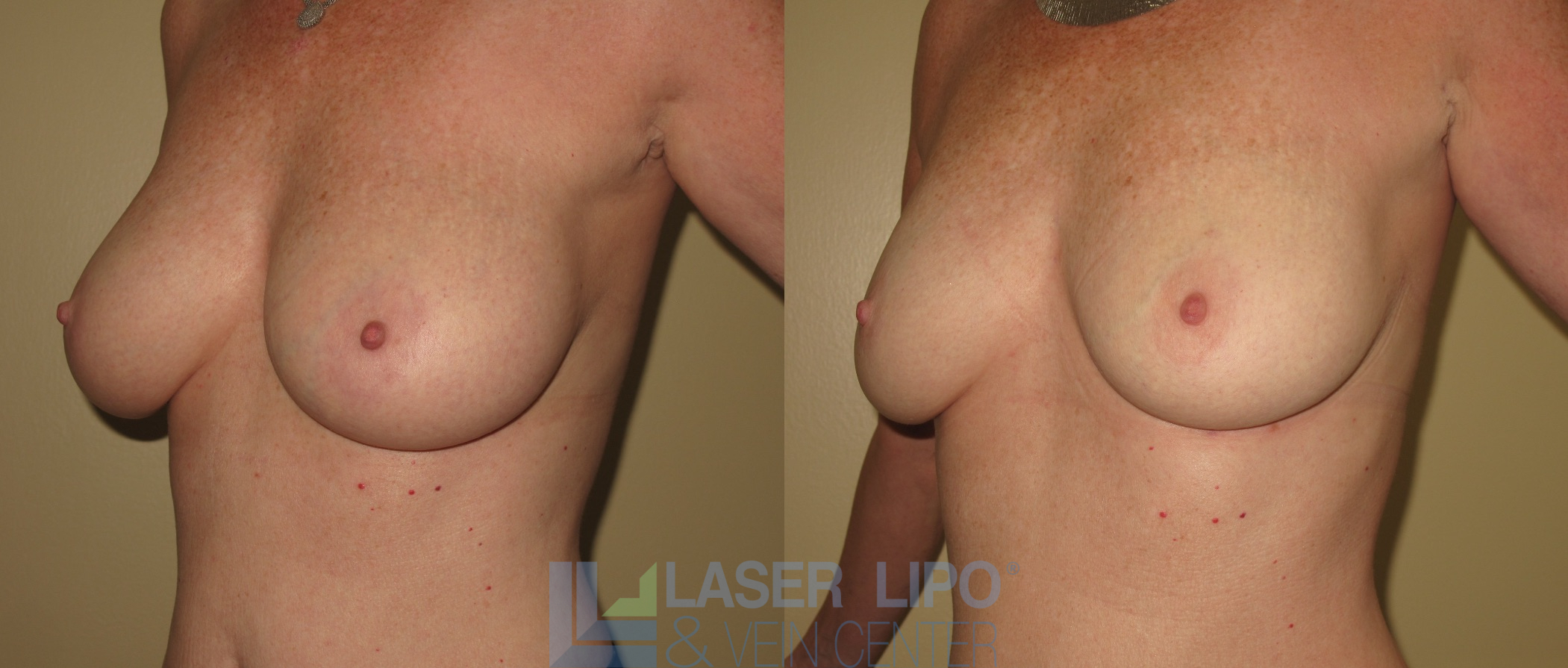 Before and After Image: Lipo/Renuvion to Breast - left-front-oblique
