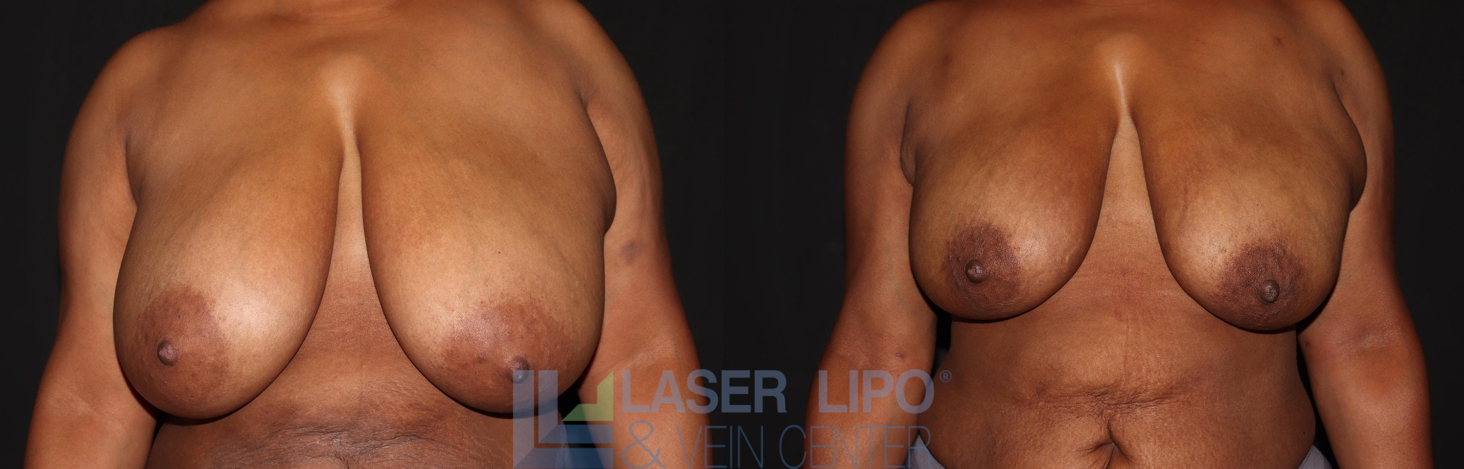 Before and After Image: Lipo/Renuvion to Breast - front