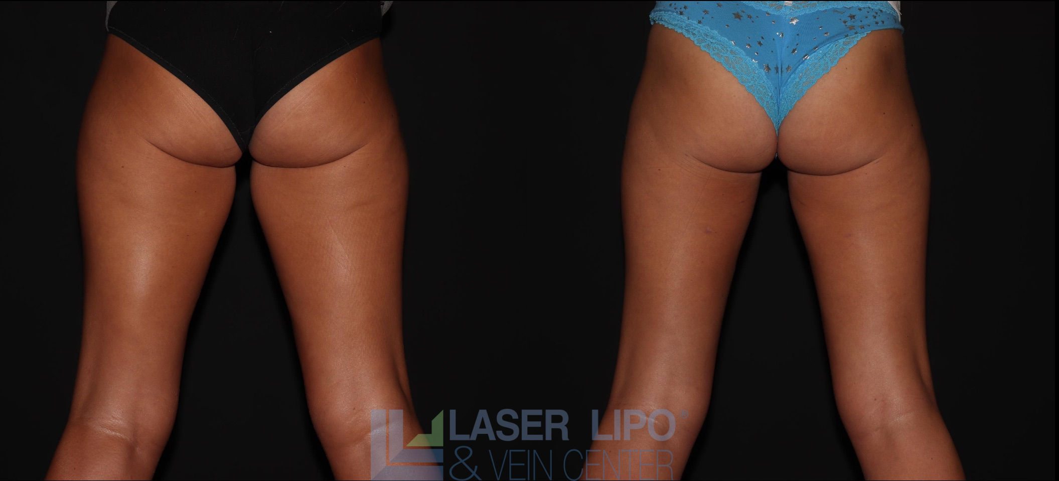 Before and After Image: Liposuction – Thighs - back