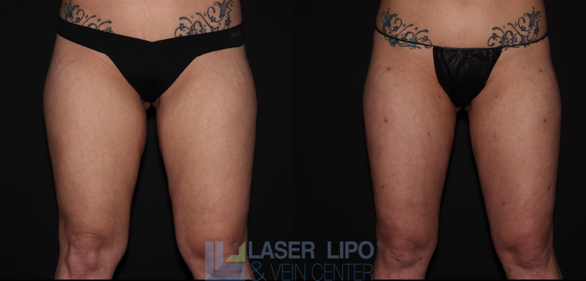 Before and After Image: Liposuction – Thighs - front