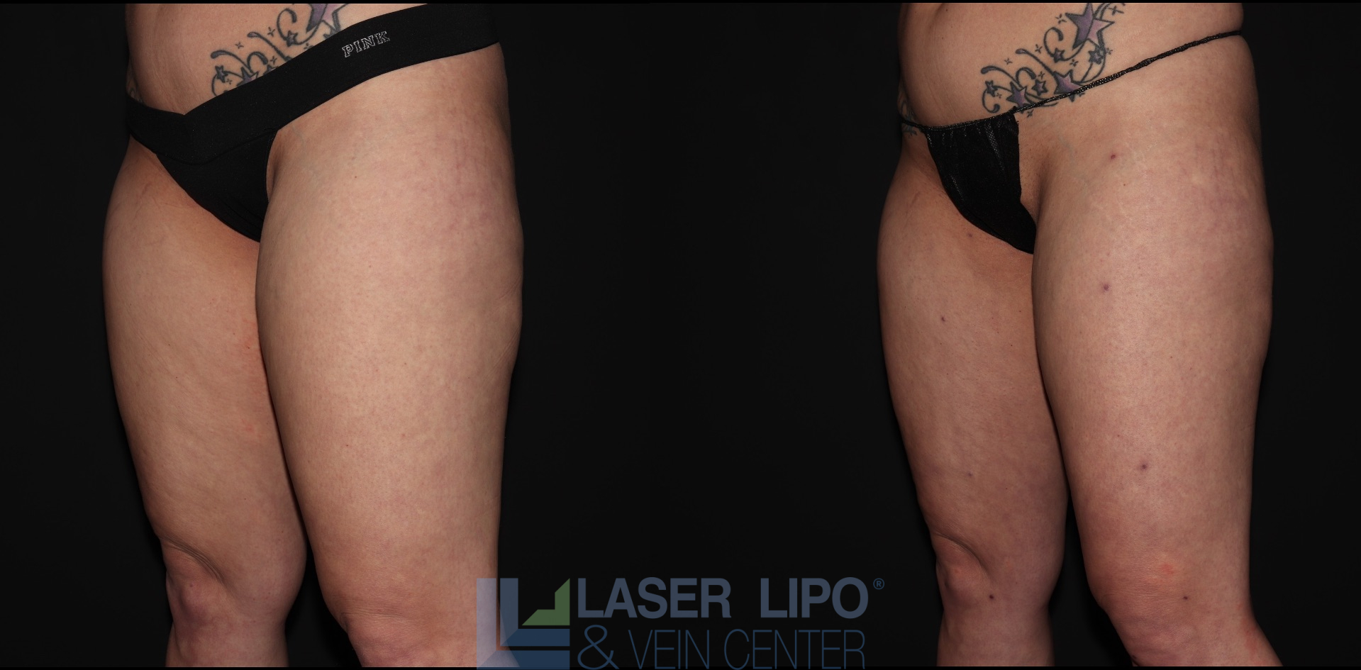 Before and After Image: Liposuction – Thighs - left-front-oblique