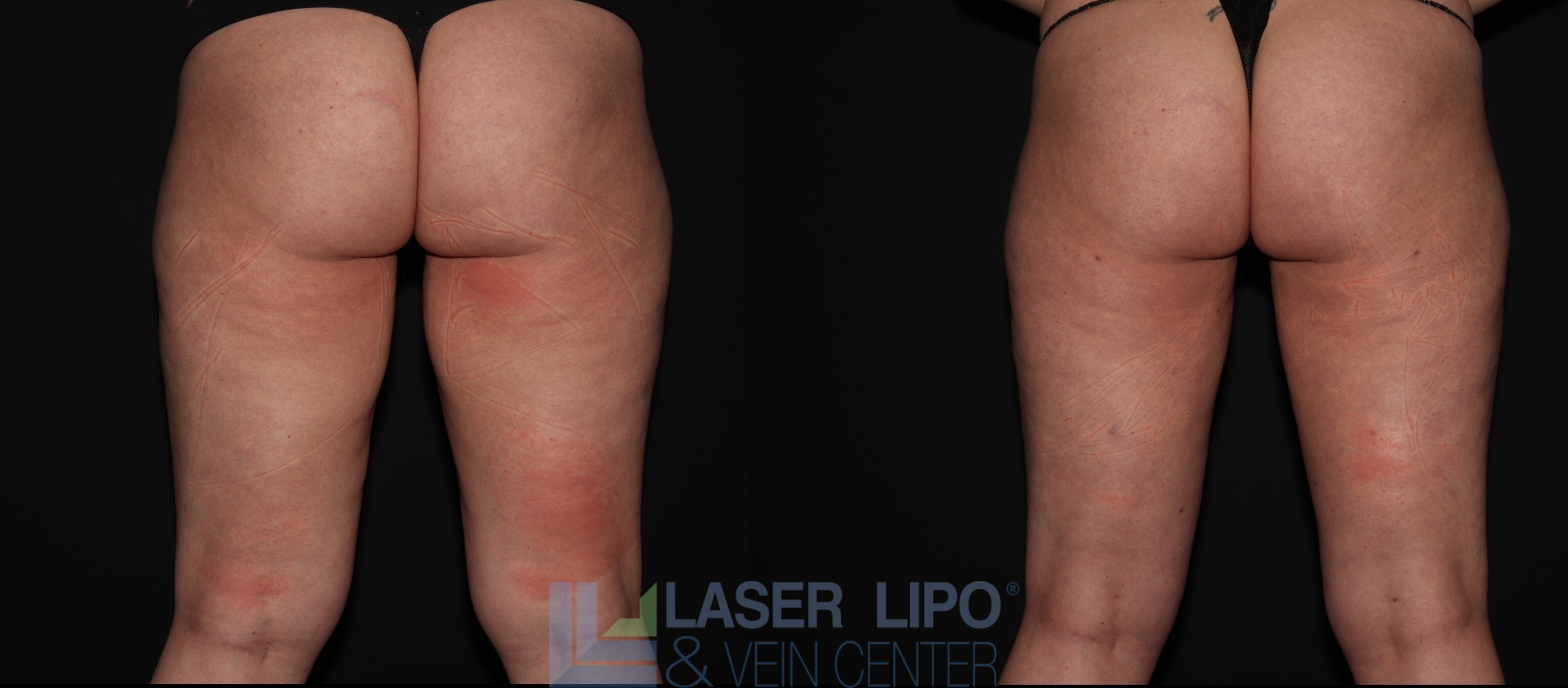 Before and After Image: Liposuction – Thighs - back