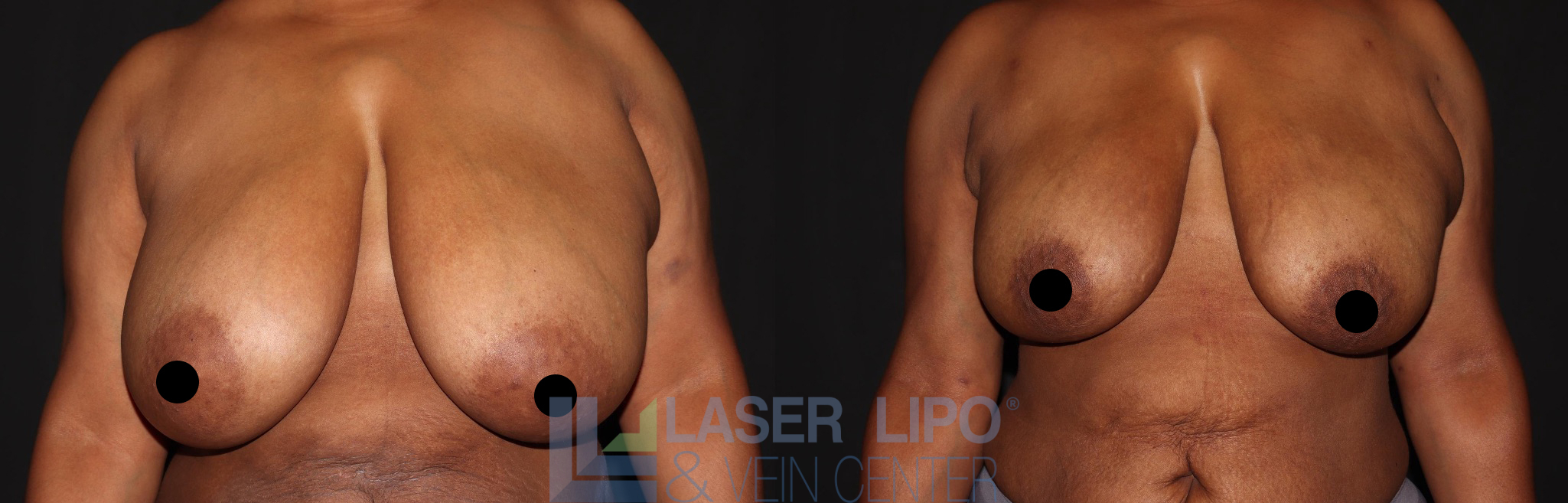 Before and After Image: Lipo/Renuvion to Breast - front