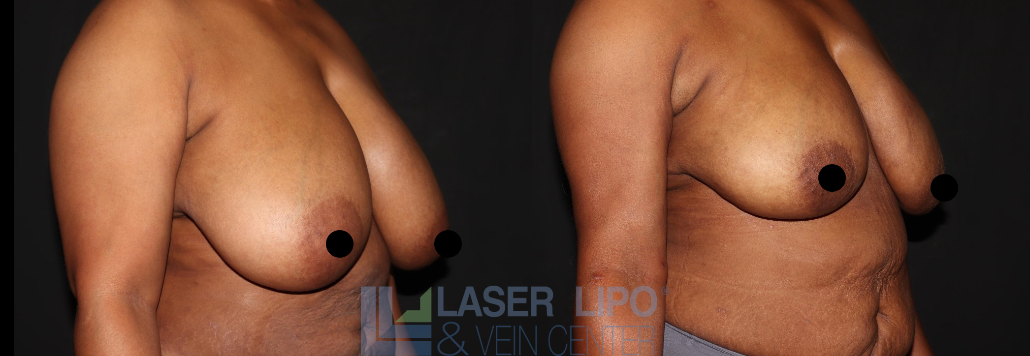 Before and After Image: Lipo/Renuvion to Breast - right-front-oblique