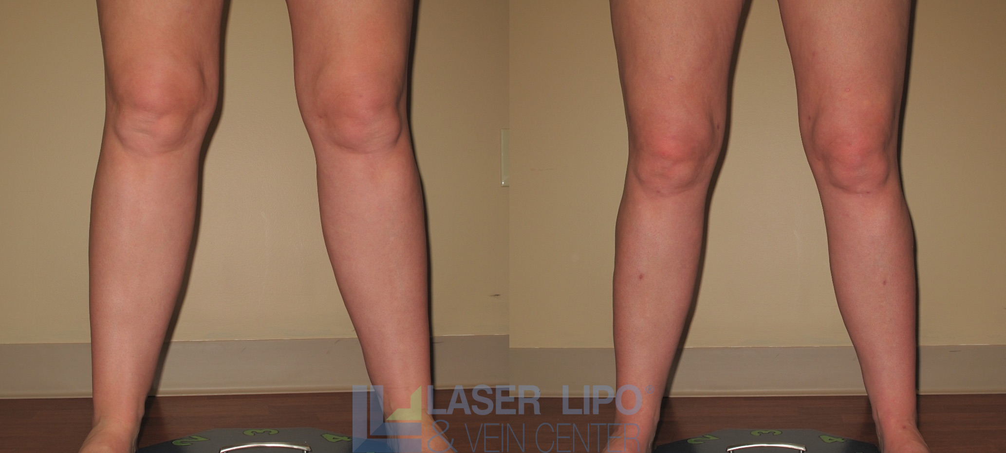 Before and After Image: Liposuction – Calves - front