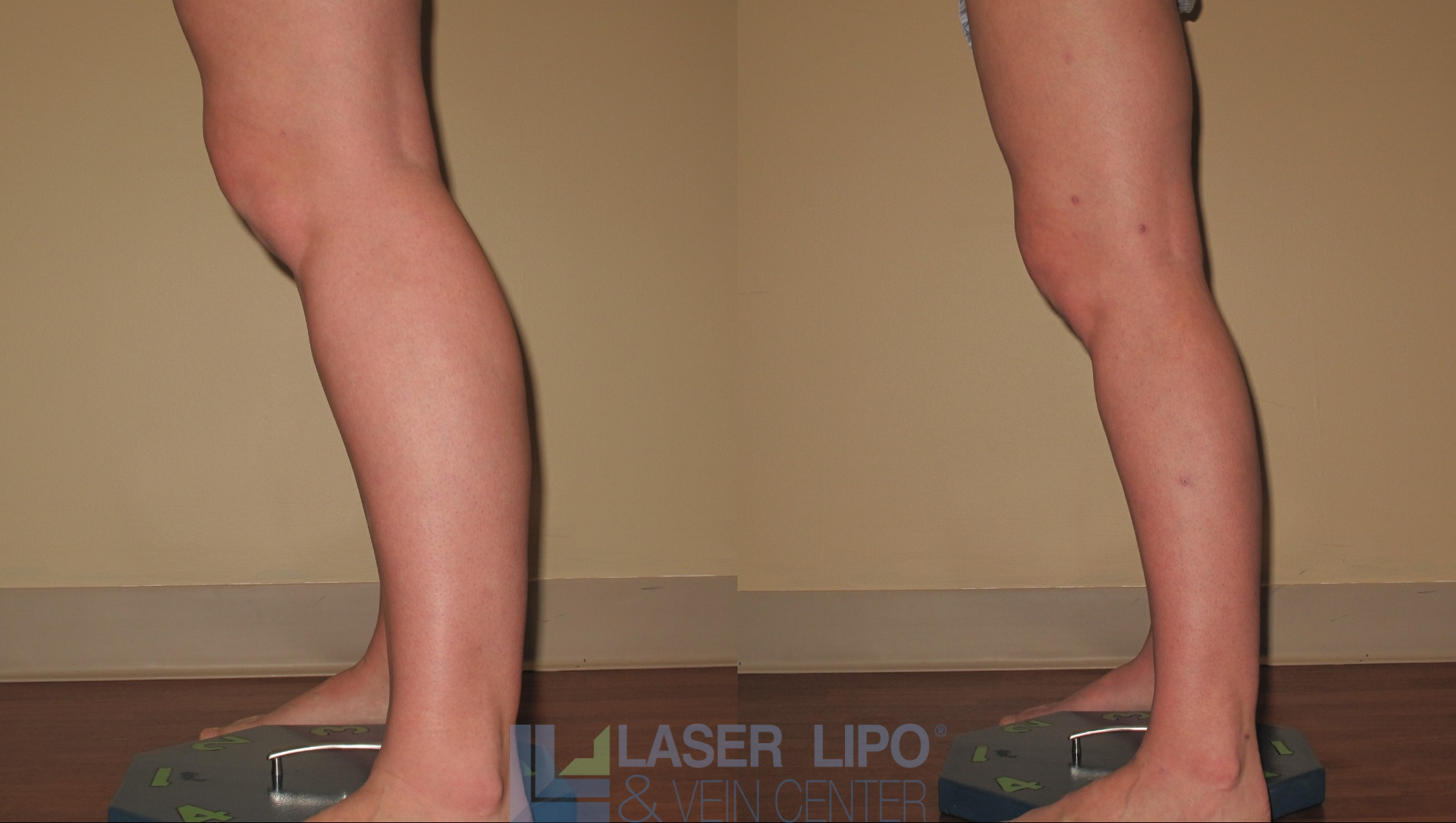 Before and After Image: Liposuction – Calves - left-side