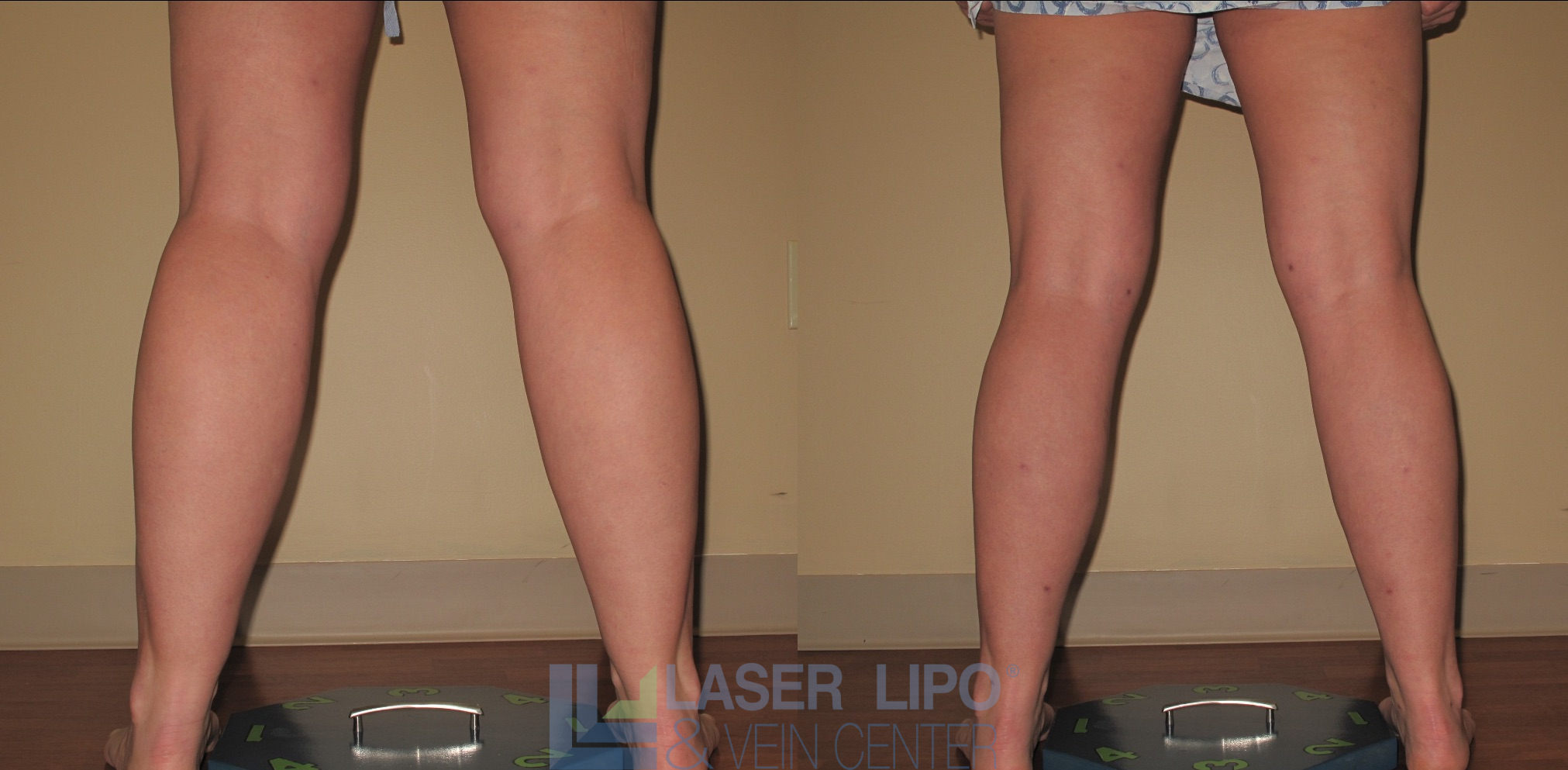 Before and After Image: Liposuction – Calves - back