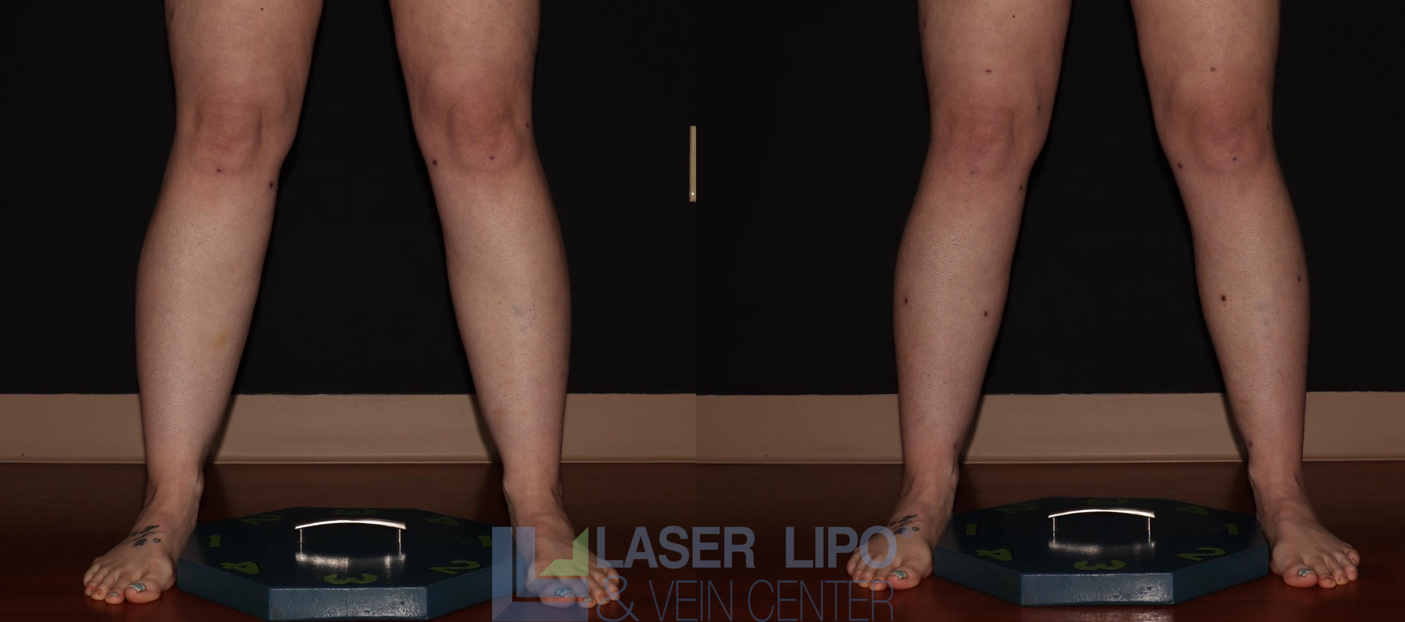 Before and After Image: Liposuction – Calves - front