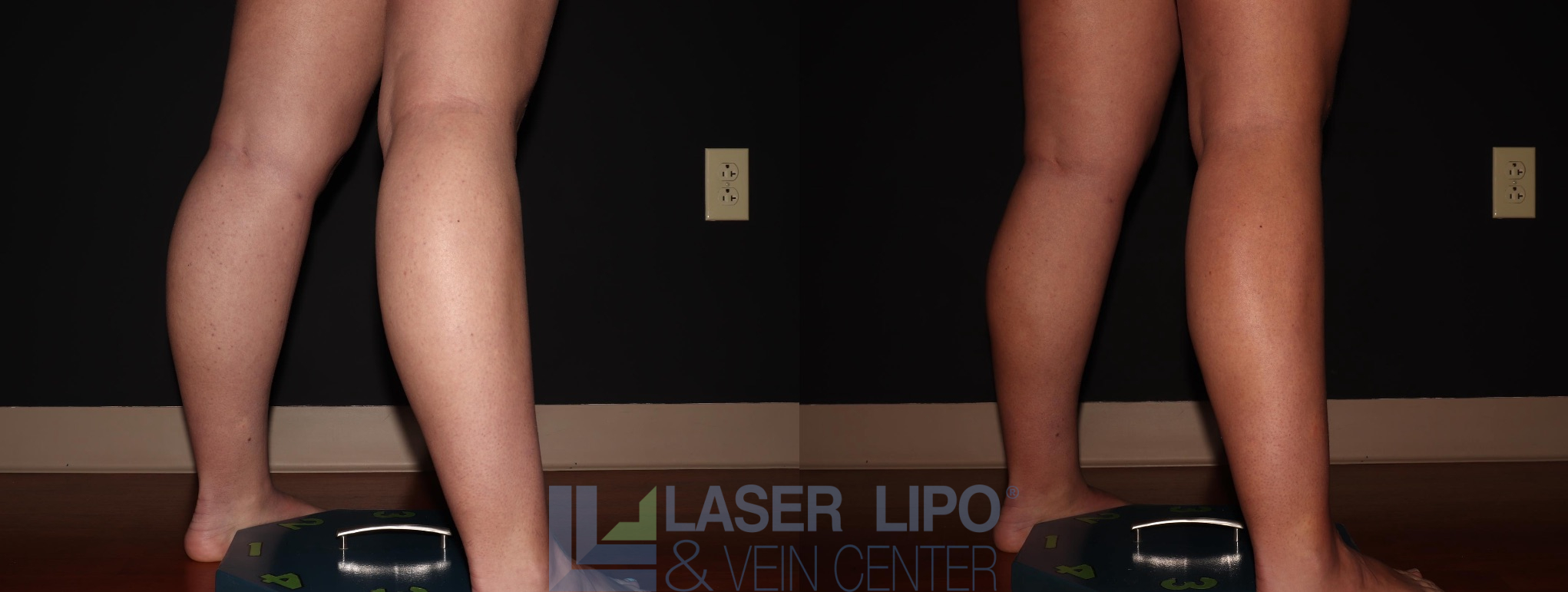Before and After Image: Liposuction – Calves - right-back-oblique