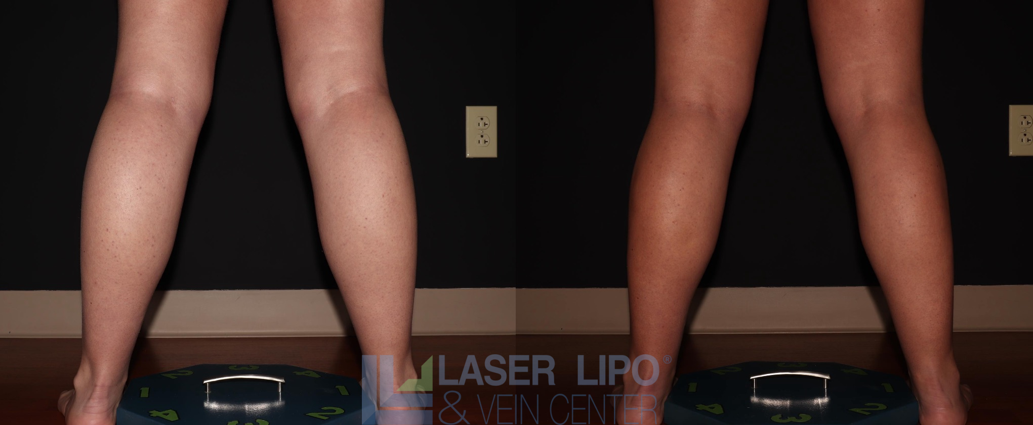 Before and After Image: Liposuction – Calves - back