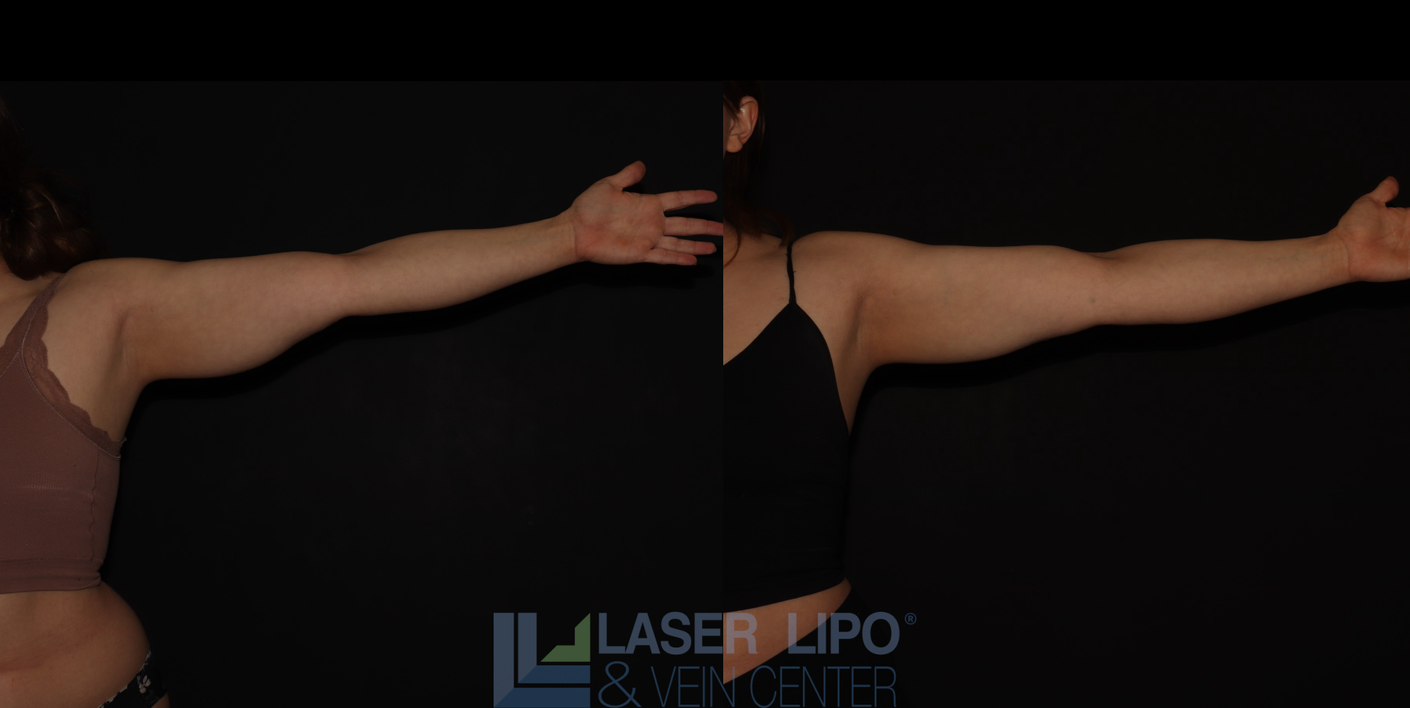 Before and After Image: Stage 1 – Arms - front