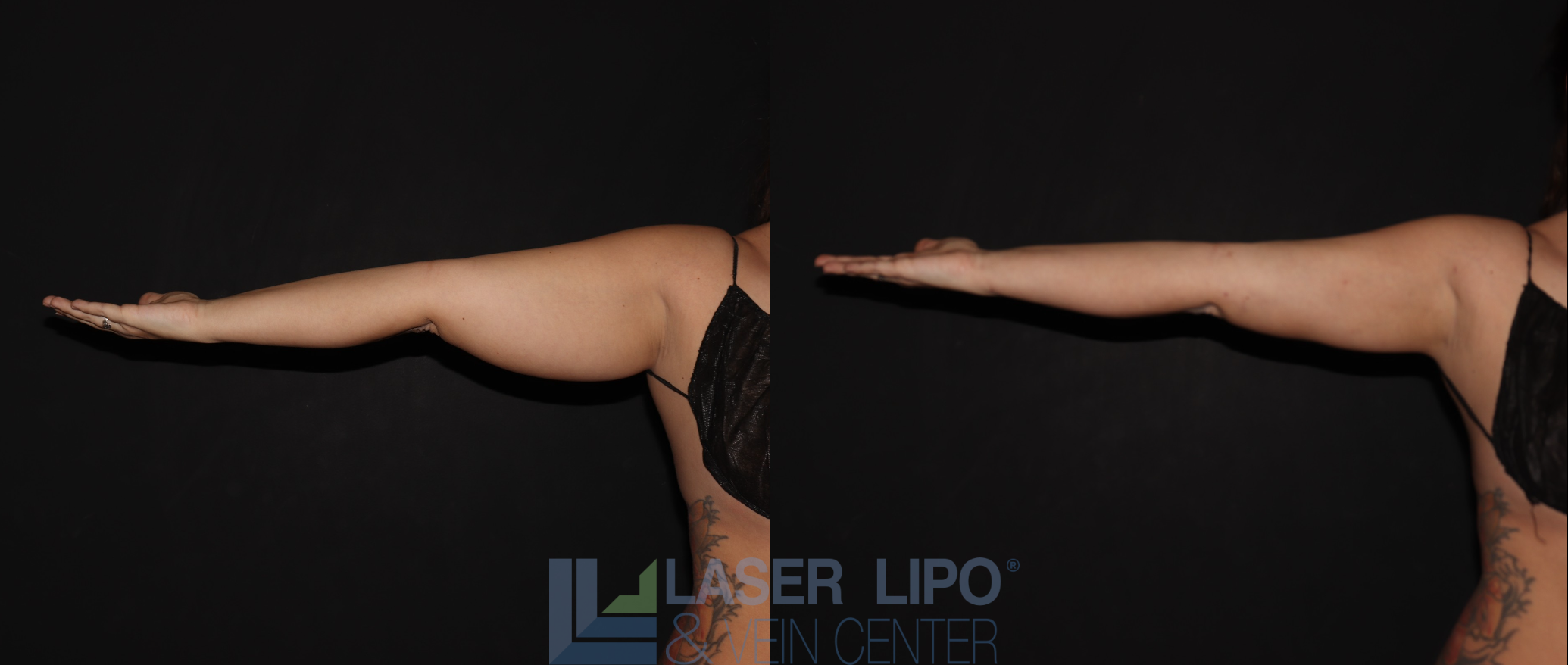 Before and After Image: Stage 1 – Arms - front