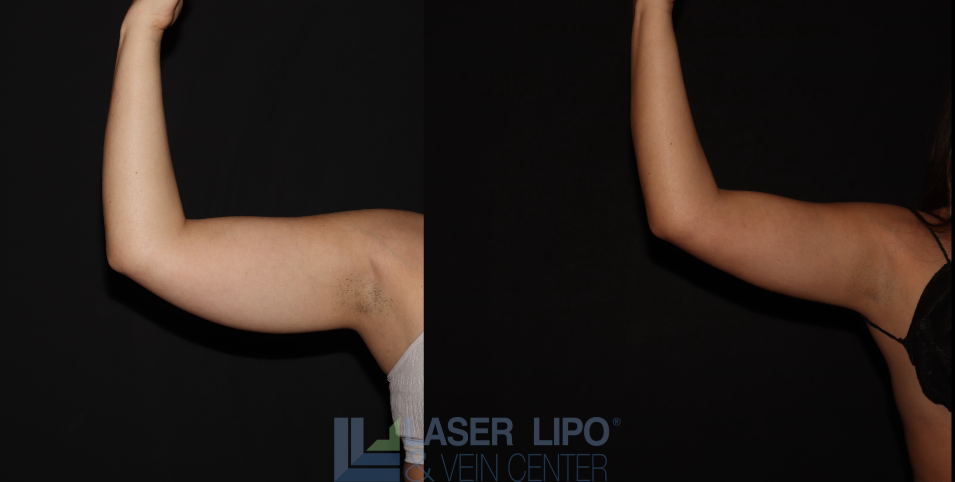 Before and After Image: Stage 1 – Arms - front