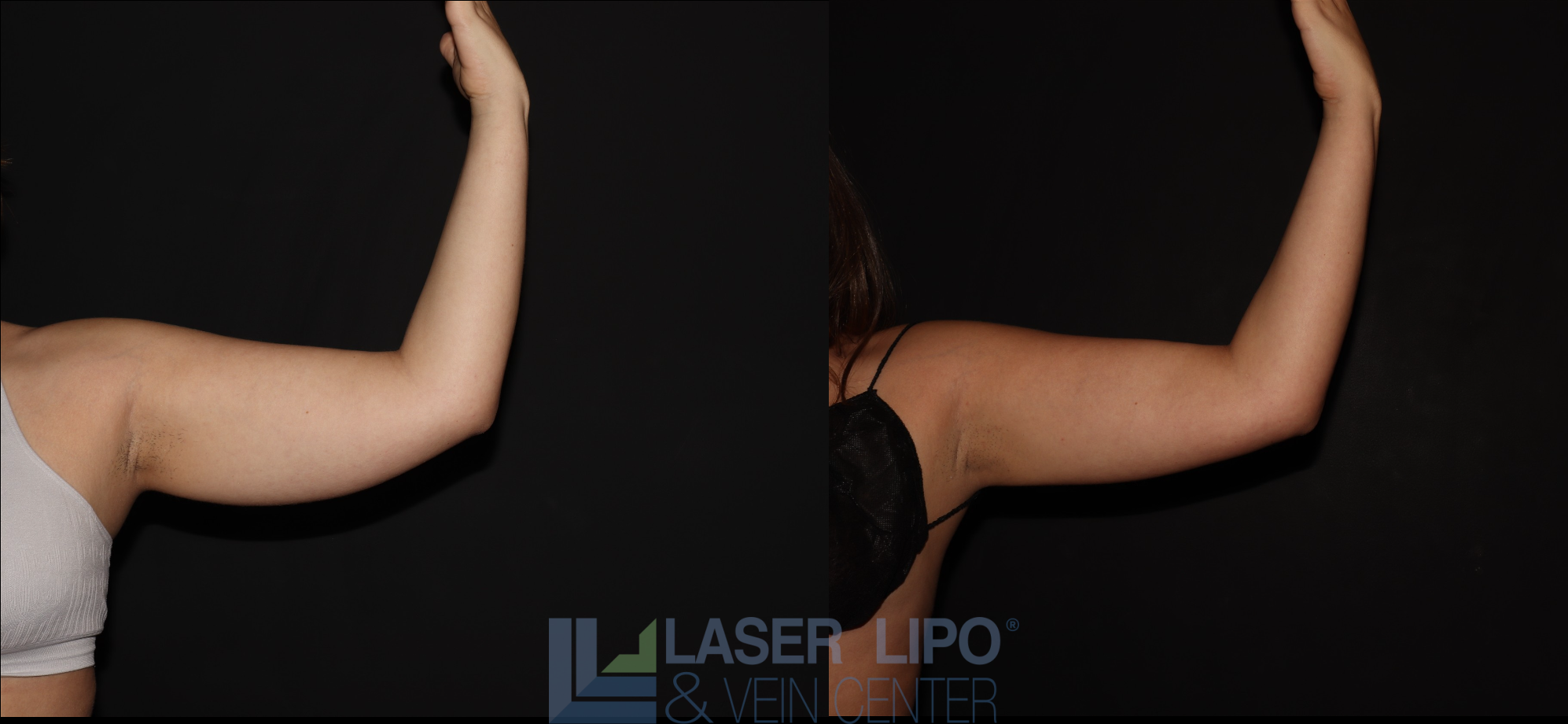 Before and After Image: Stage 1 – Arms - front