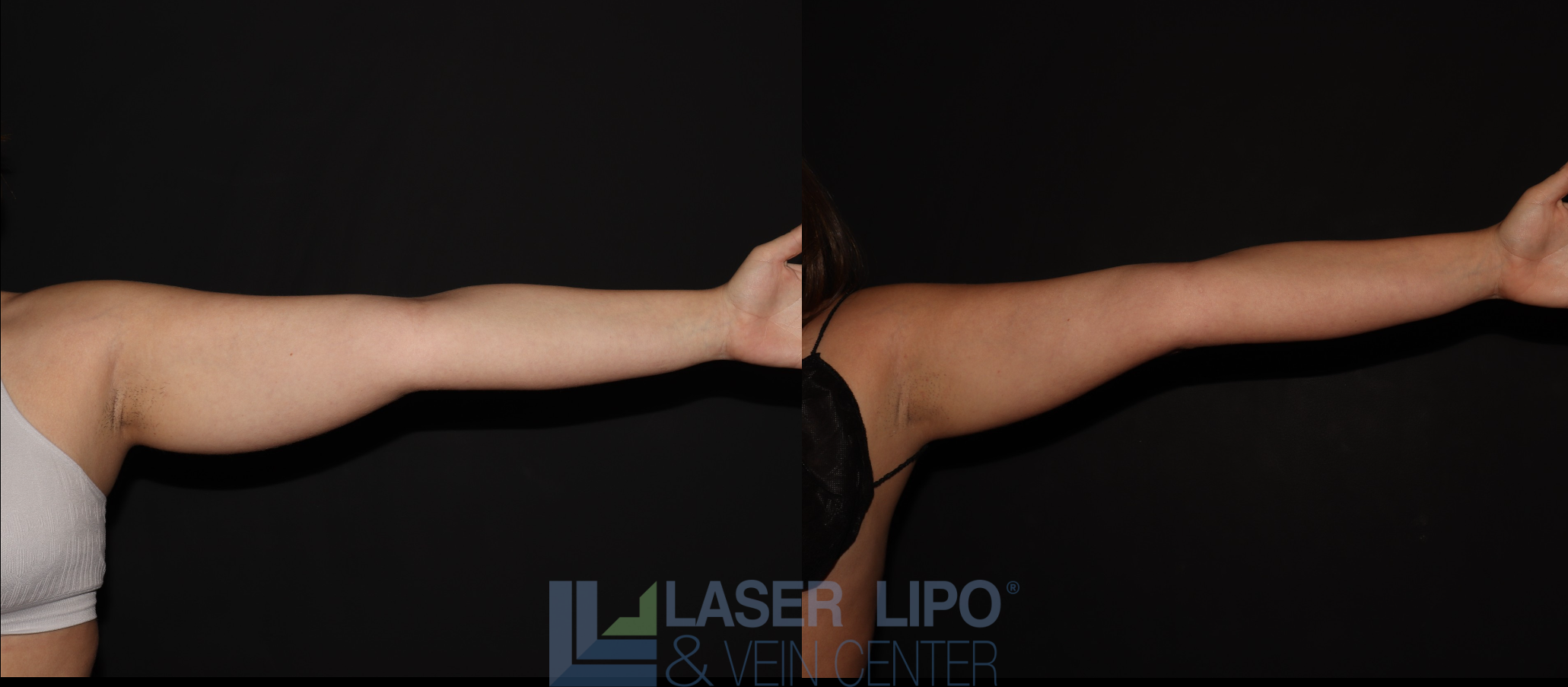 Before and After Image: Stage 1 – Arms - front