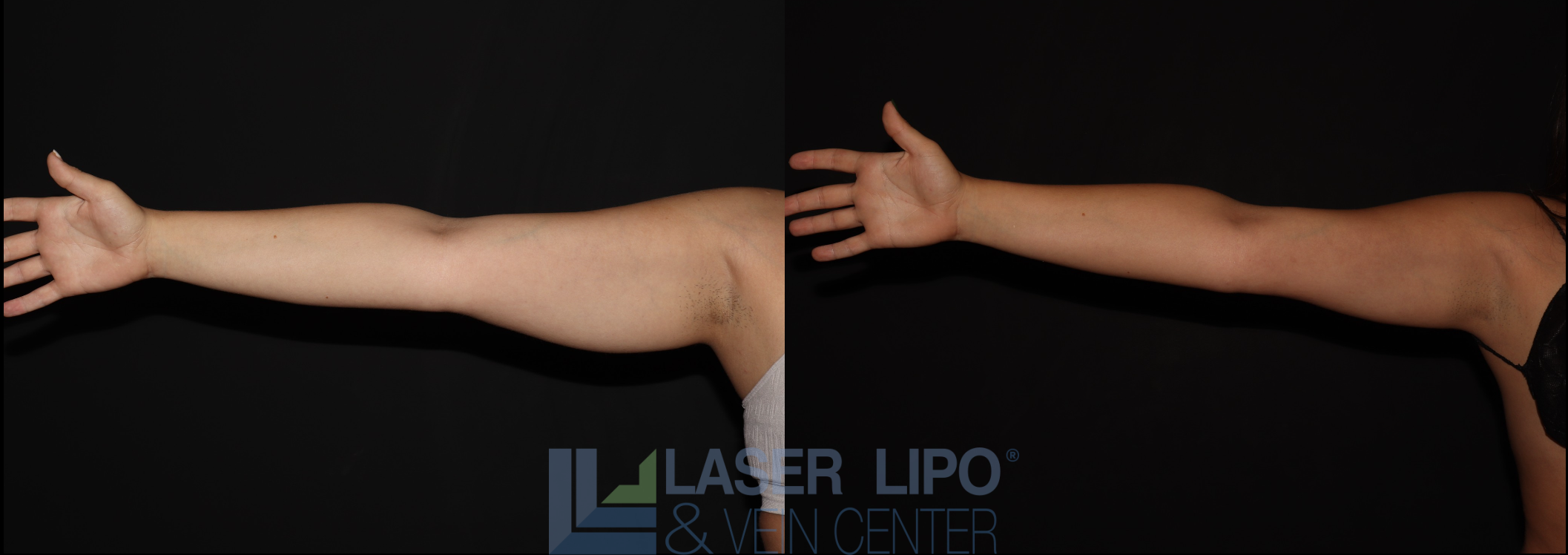 Before and After Image: Stage 1 – Arms - front