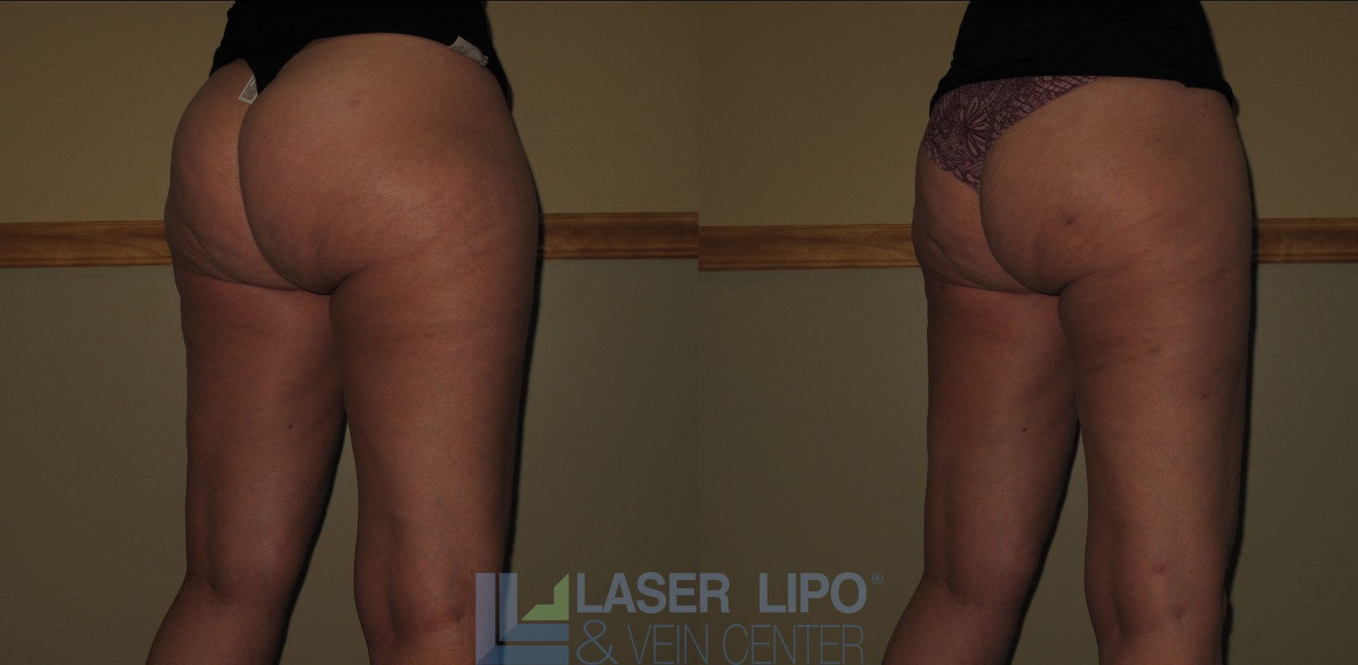 Before and After Image: Stage 1 – Buttocks-Lat Thighs - right-back-oblique