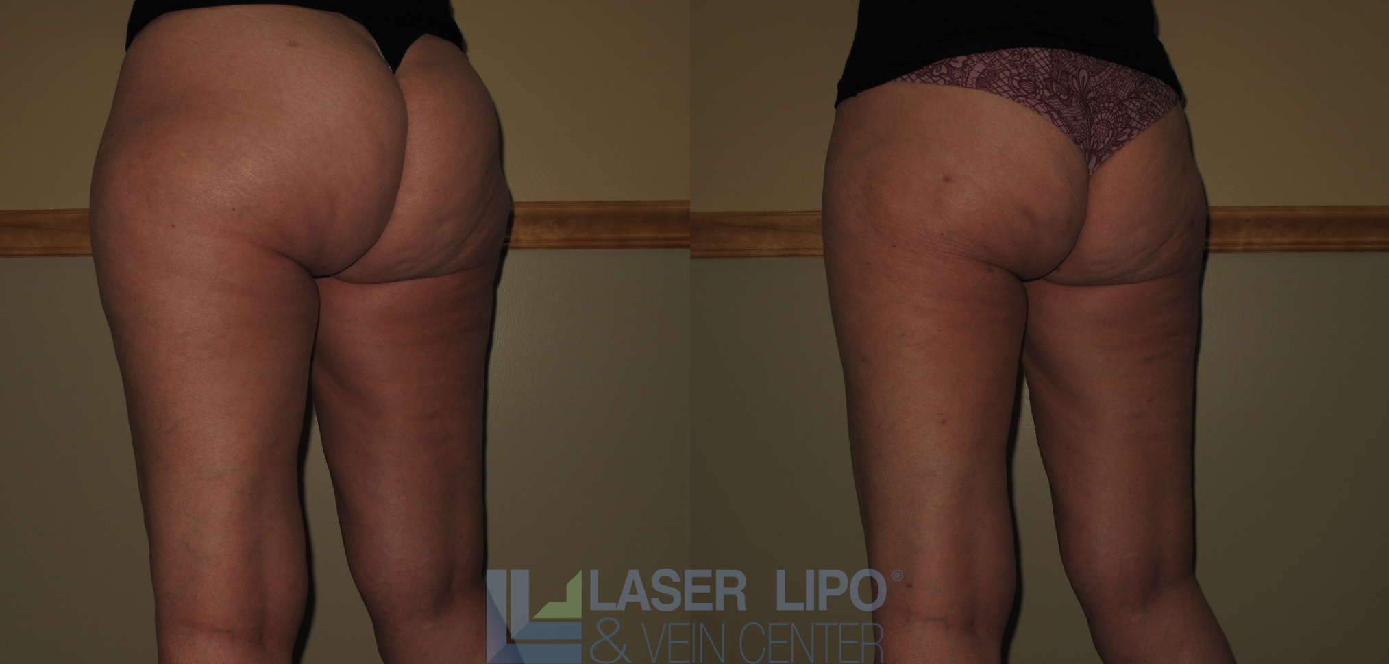 Before and After Image: Stage 1 – Buttocks-Lat Thighs - left-back-oblique