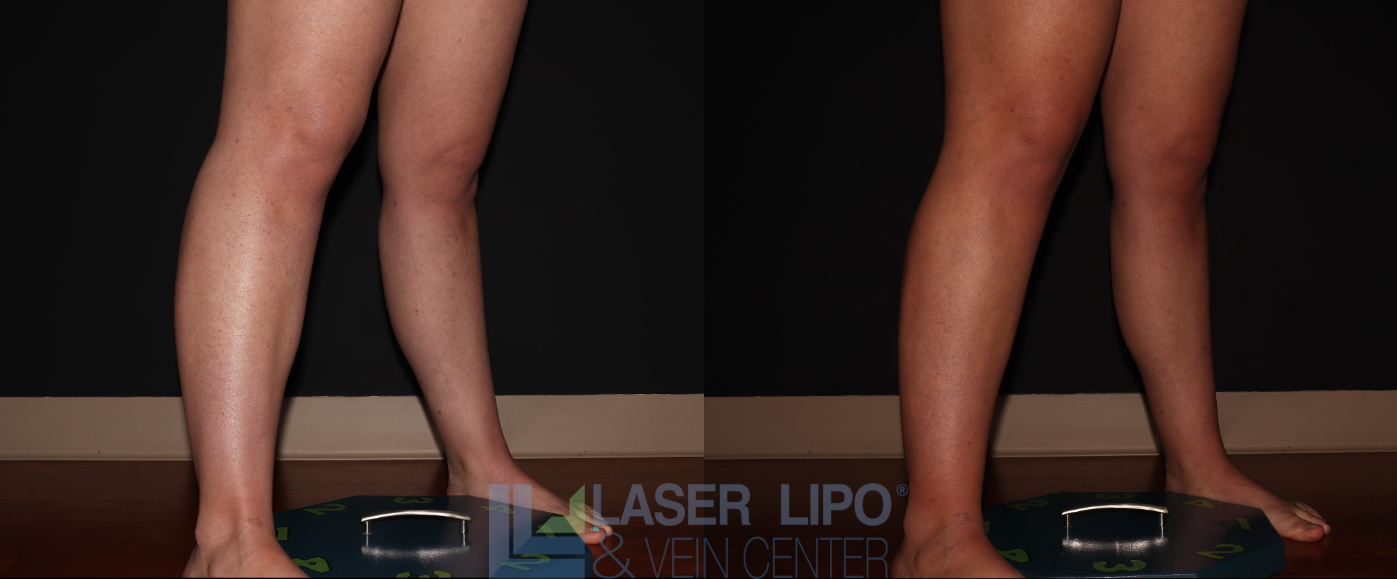 Before and After Image: Stage 1 – Calves - right-front-oblique