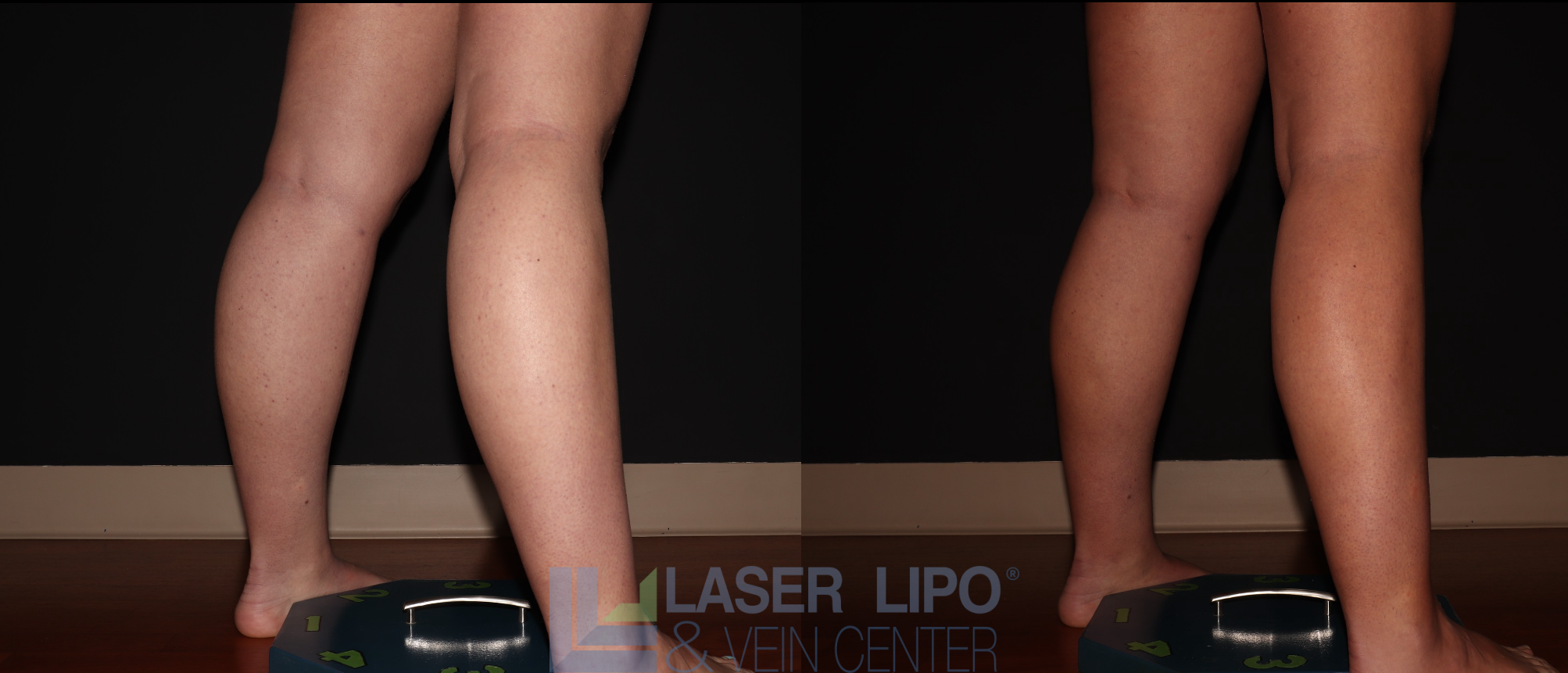 Before and After Image: Stage 1 – Calves - right-back-oblique
