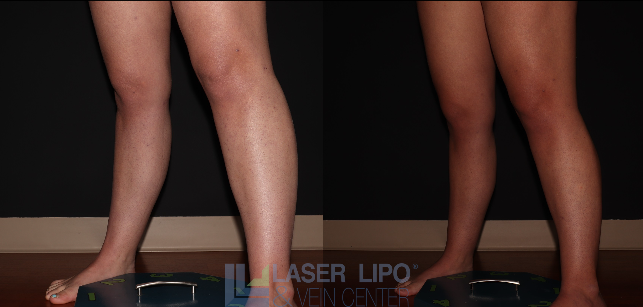 Before and After Image: Stage 1 – Calves - left-front-oblique