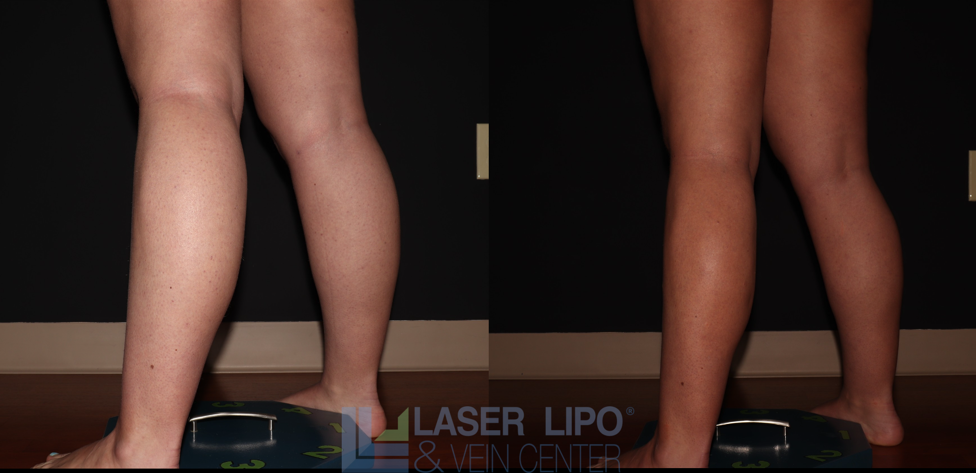 Before and After Image: Stage 1 – Calves - left-back-oblique