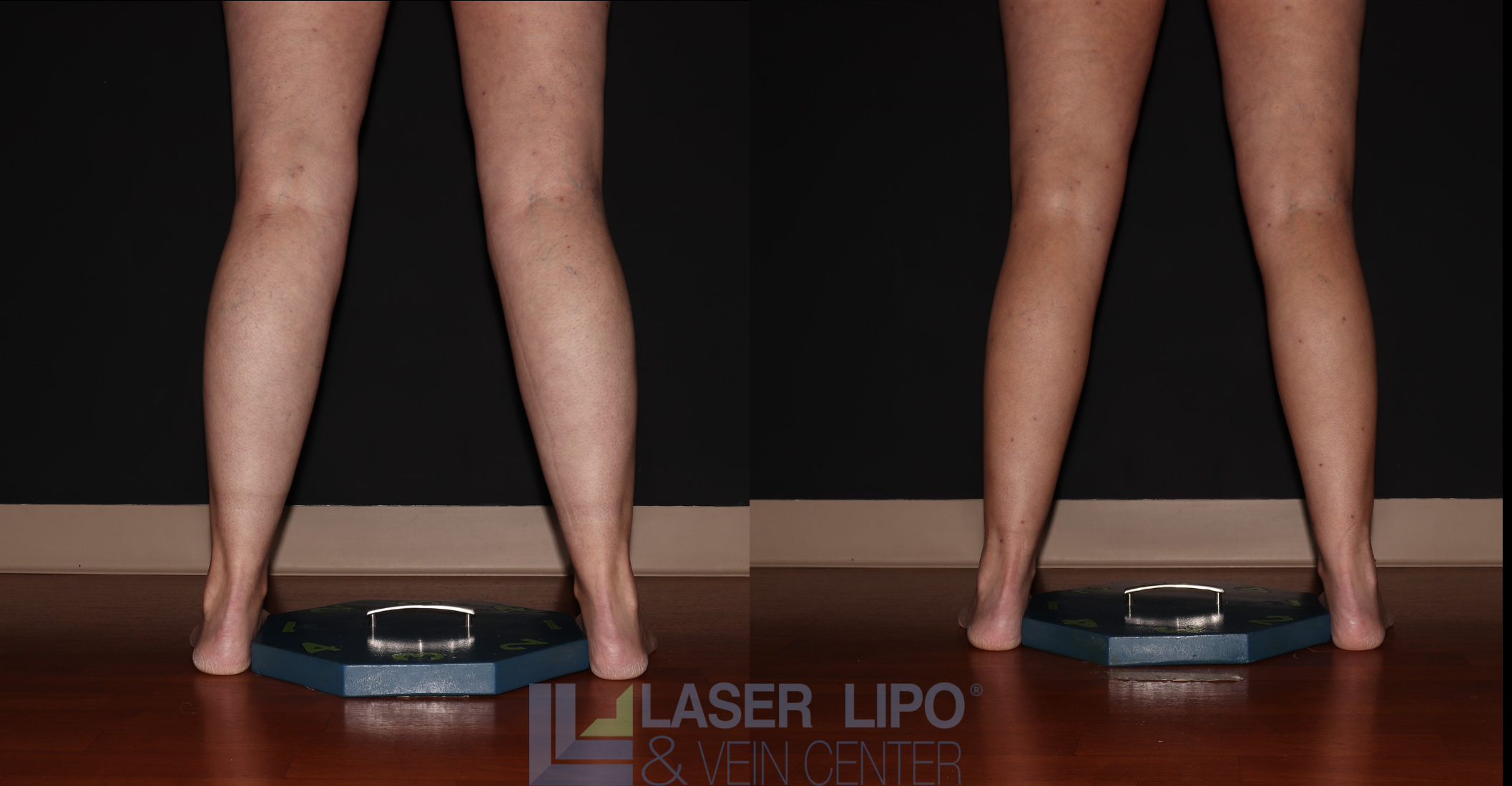 Before and After Image: Stage 1 – Calves - back