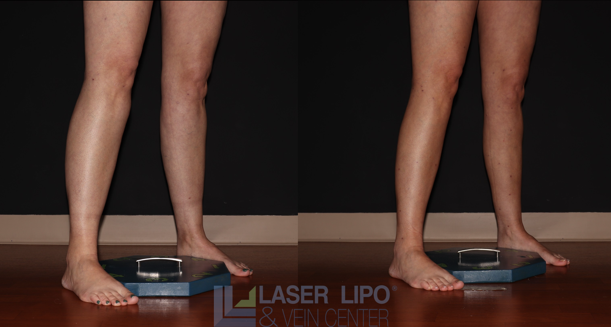 Before and After Image: Stage 1 – Calves - right-front-oblique