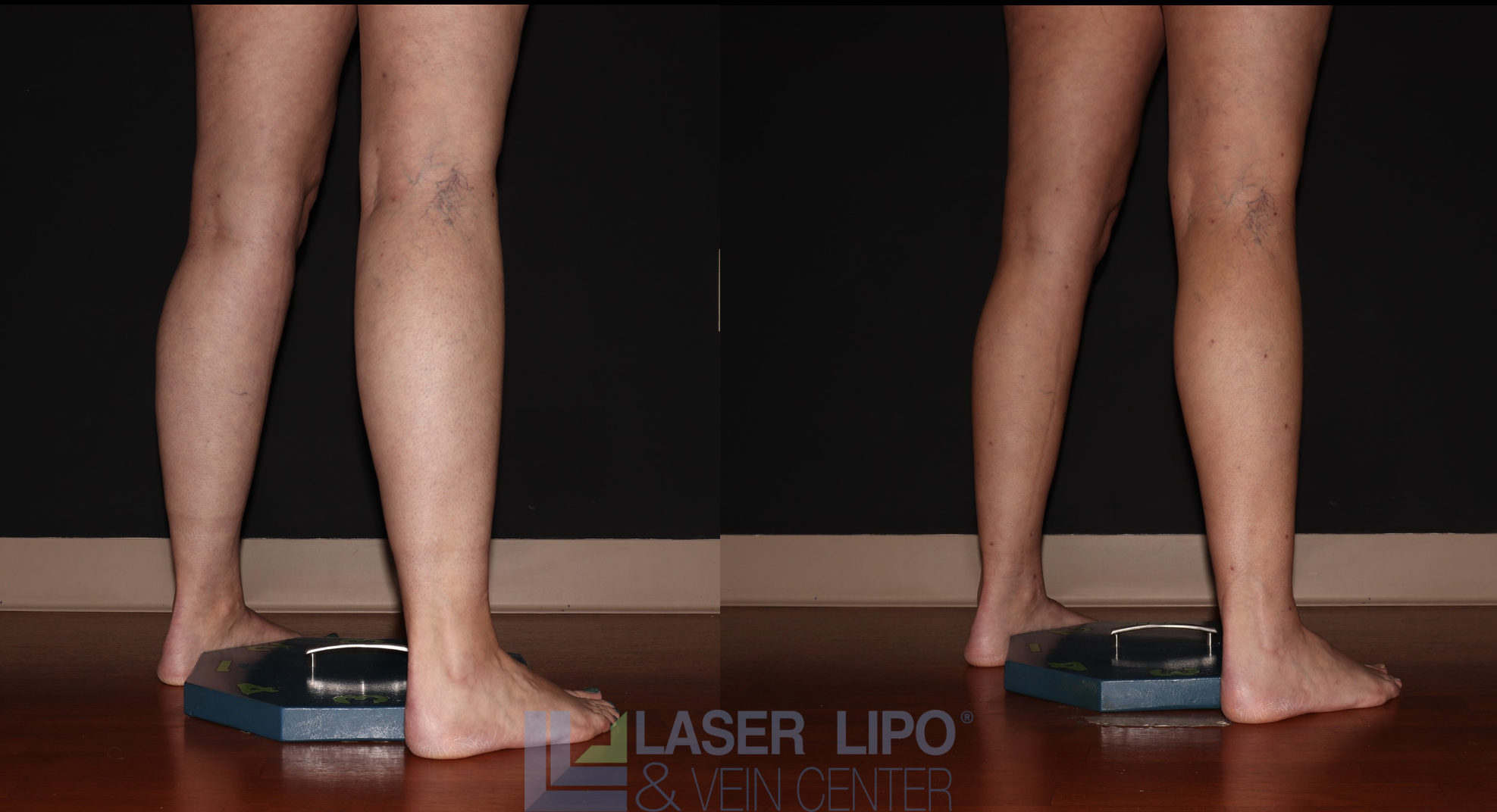 Before and After Image: Stage 1 – Calves - right-back-oblique