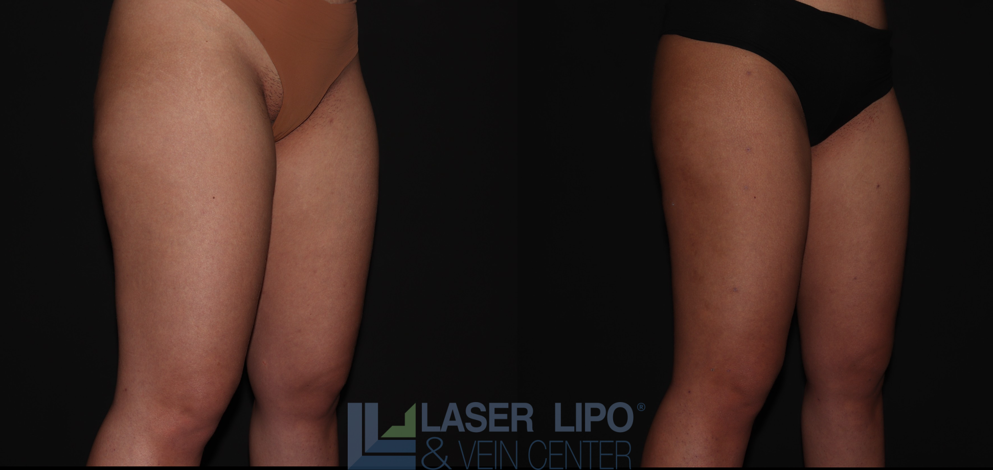 Before and After Image: Stage 1 – Thighs - right-front-oblique