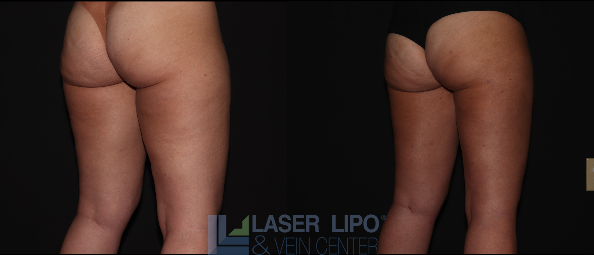 Before and After Image: Stage 1 – Thighs - right-back-oblique