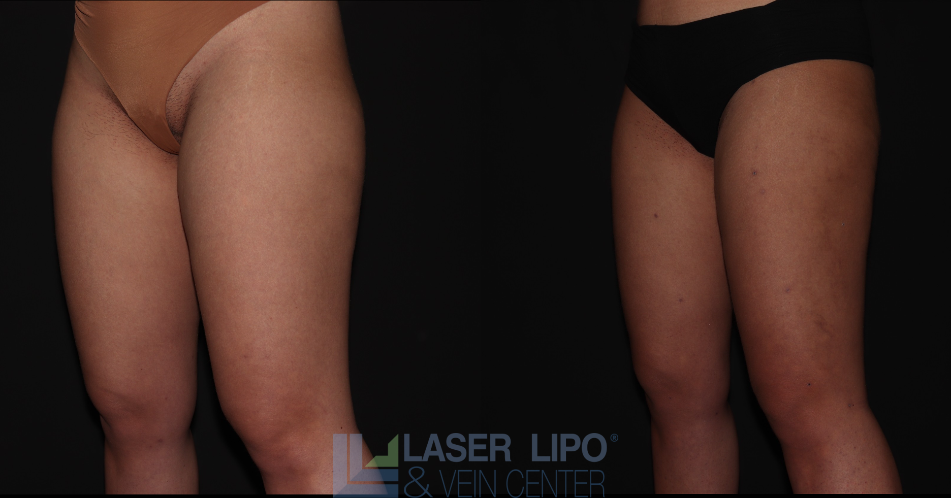 Before and After Image: Stage 1 – Thighs - left-front-oblique