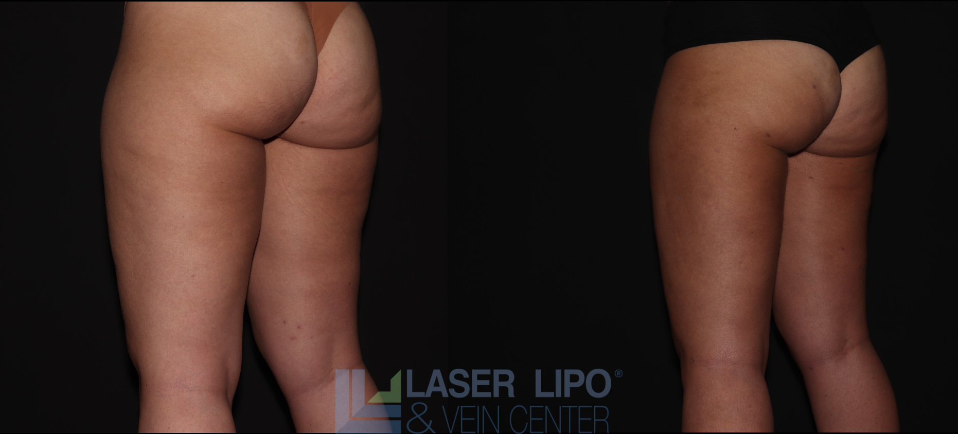 Before and After Image: Stage 1 – Thighs - left-back-oblique