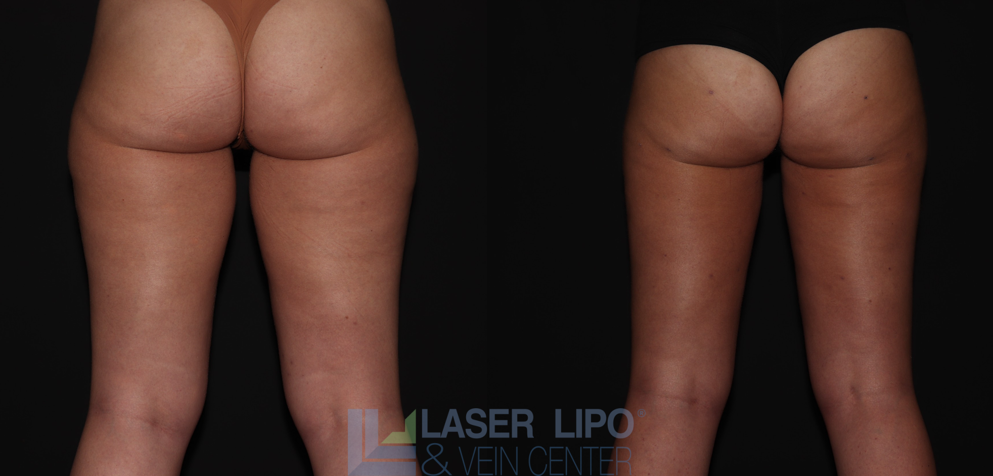 Before and After Image: Stage 1 – Thighs - back
