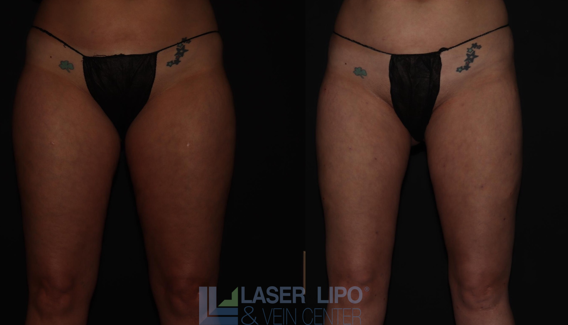Before and After Image: Stage 1 – Thighs - front